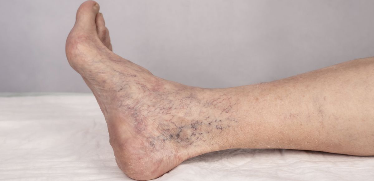 Side view of a bare foot and lower leg with dark speckled skin on a light surface.