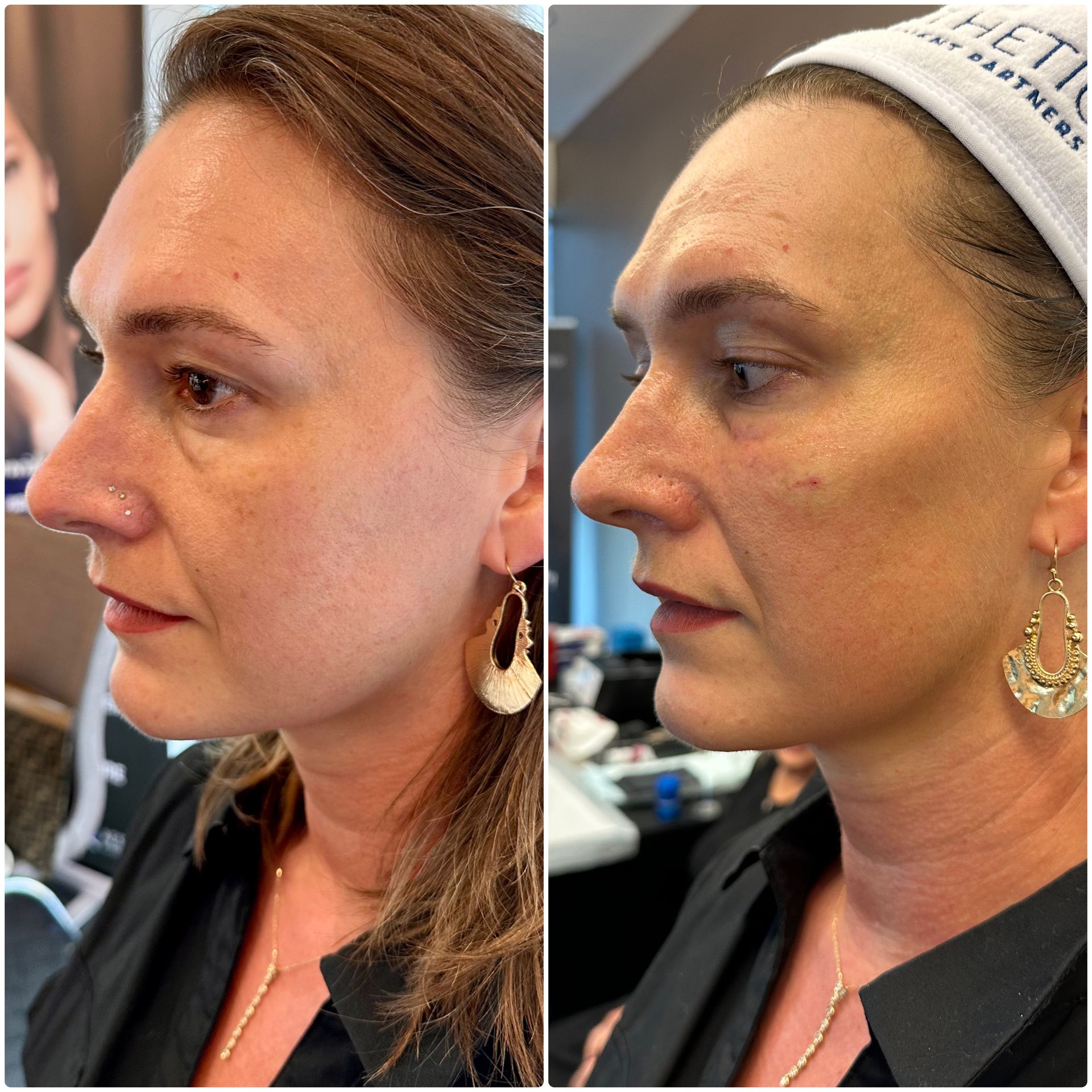 A before and after photo of a woman 's face