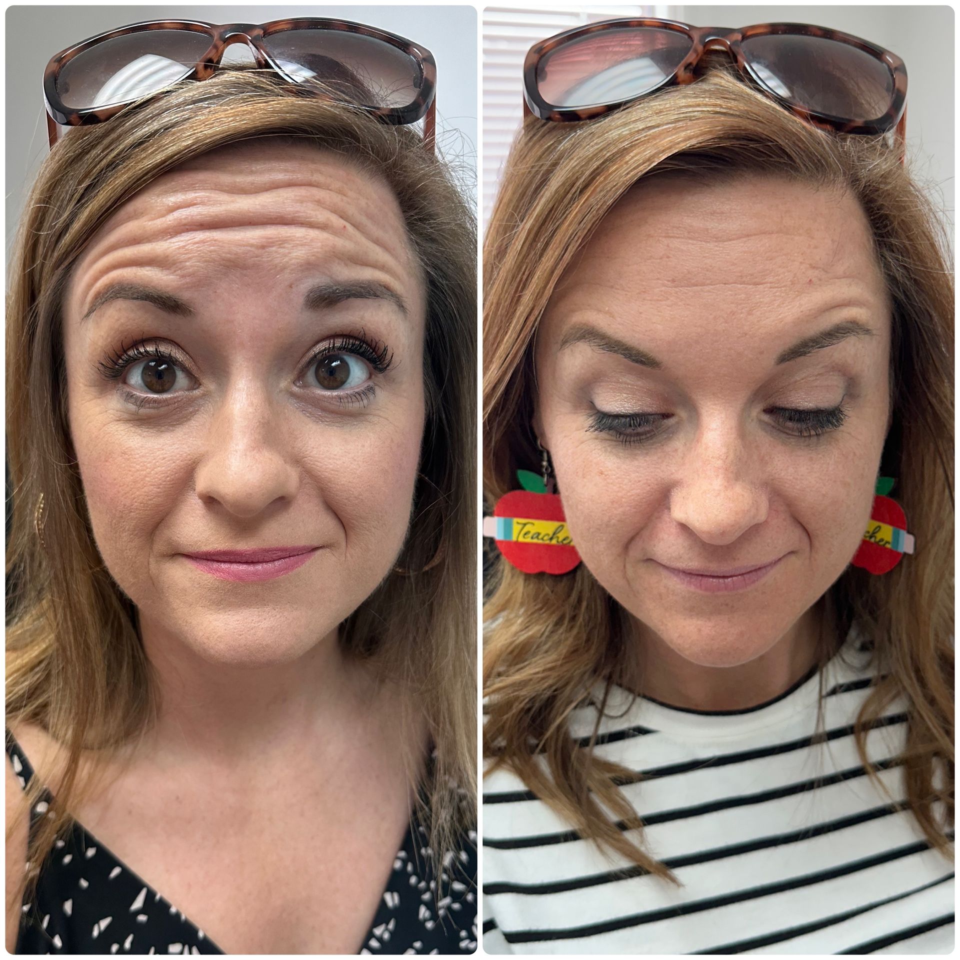 A before and after photo of a woman 's forehead.