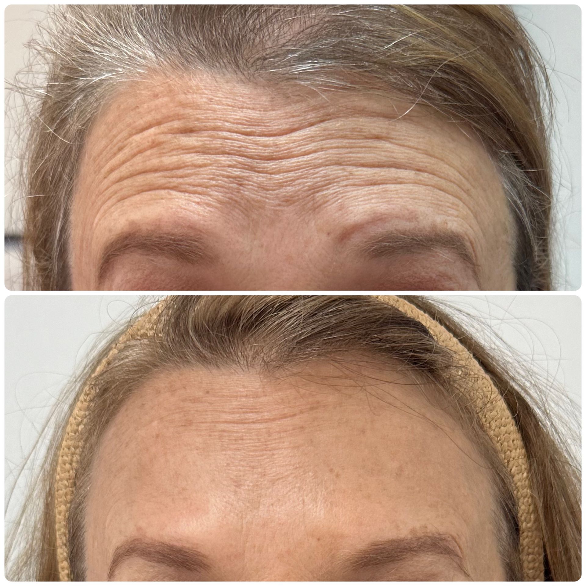 A before and after photo of a woman 's forehead with wrinkles.