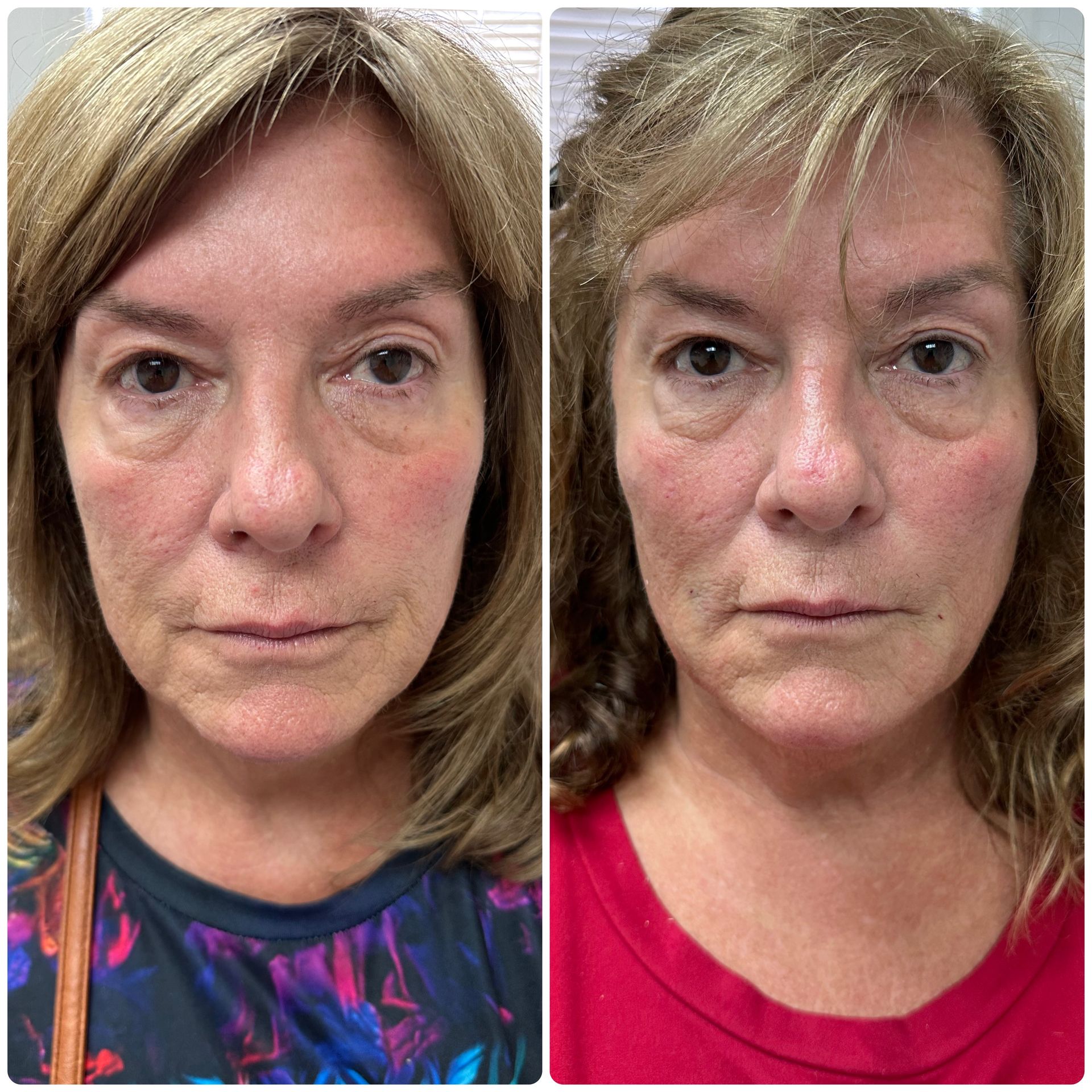 A before and after photo of a woman 's face.