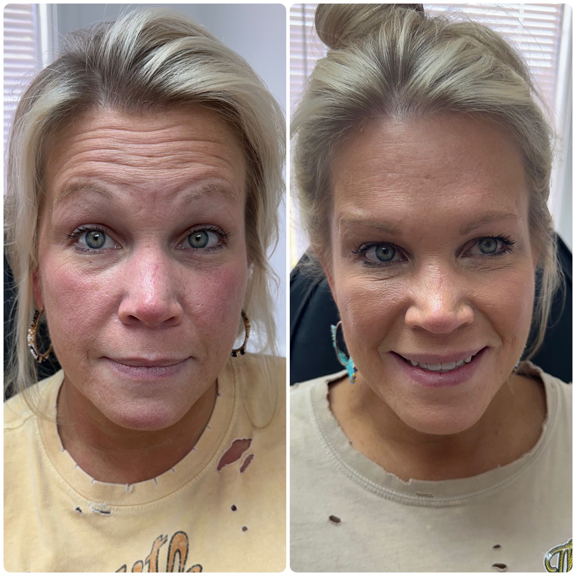 A before and after photo of a woman 's forehead.