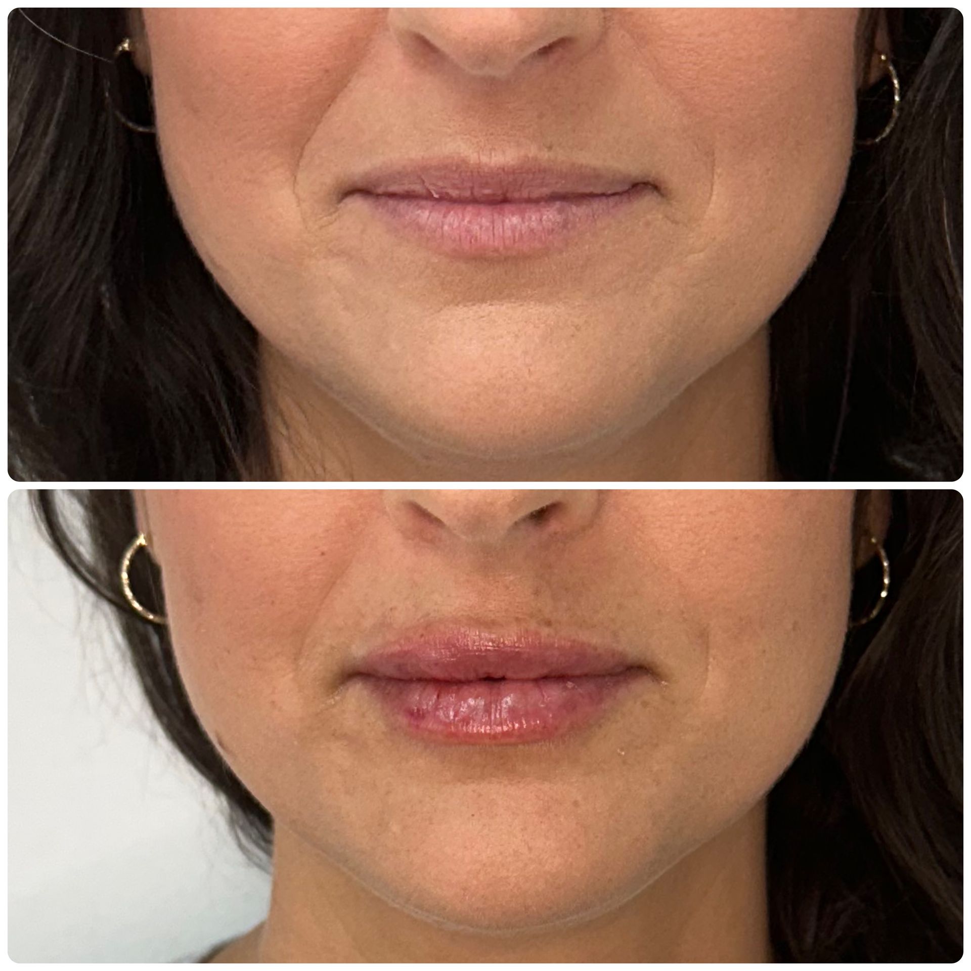 A before and after photo of a woman 's lips.