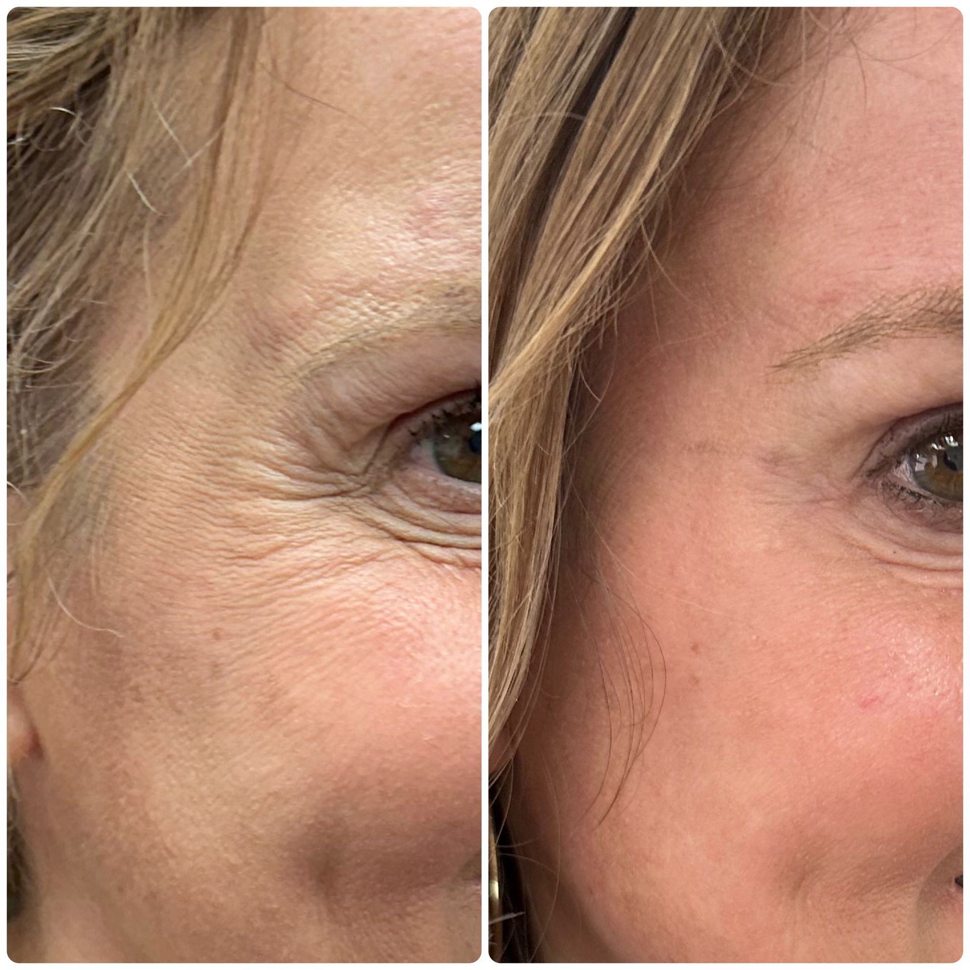 A before and after photo of a woman 's face with wrinkles.