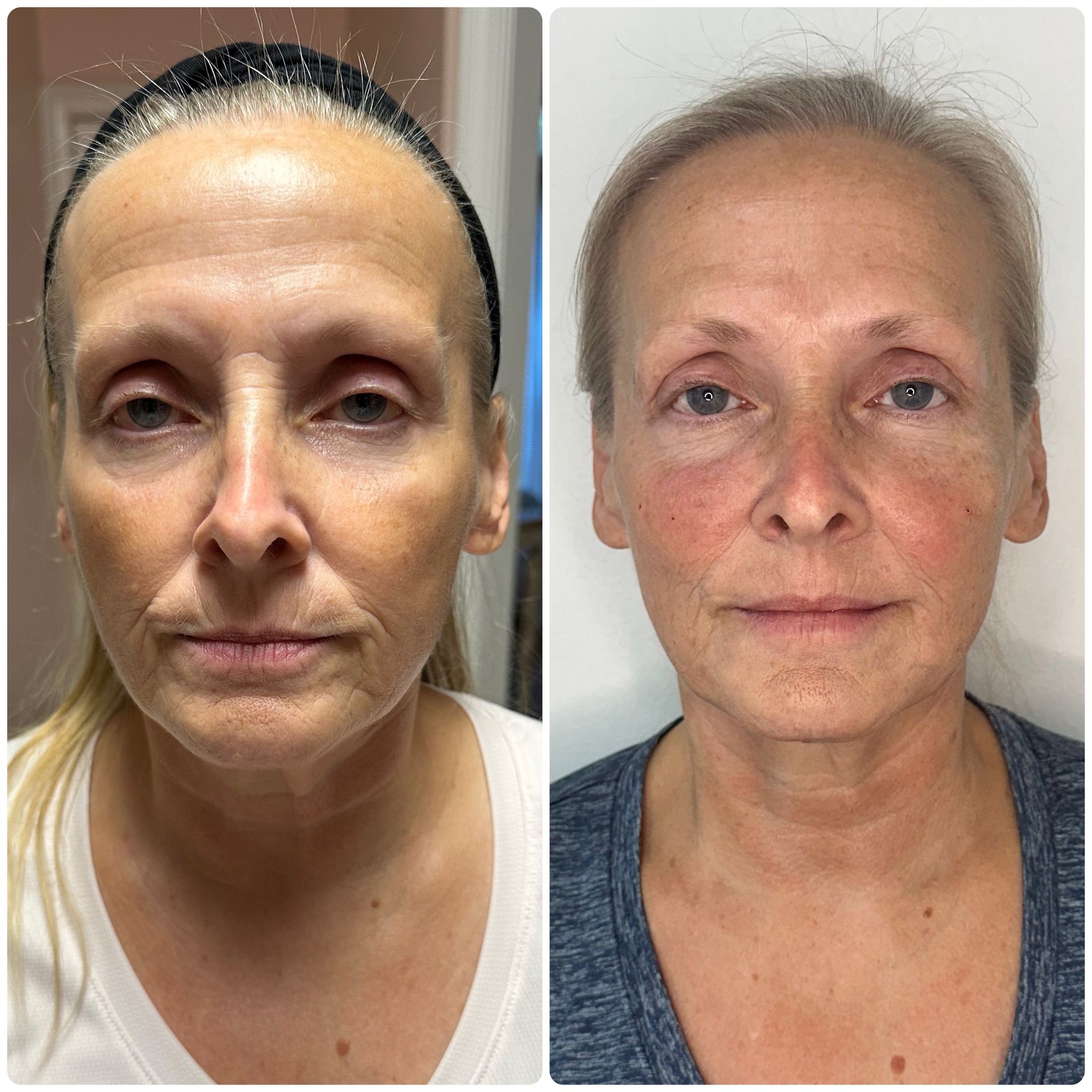 A before and after photo of a woman 's face.