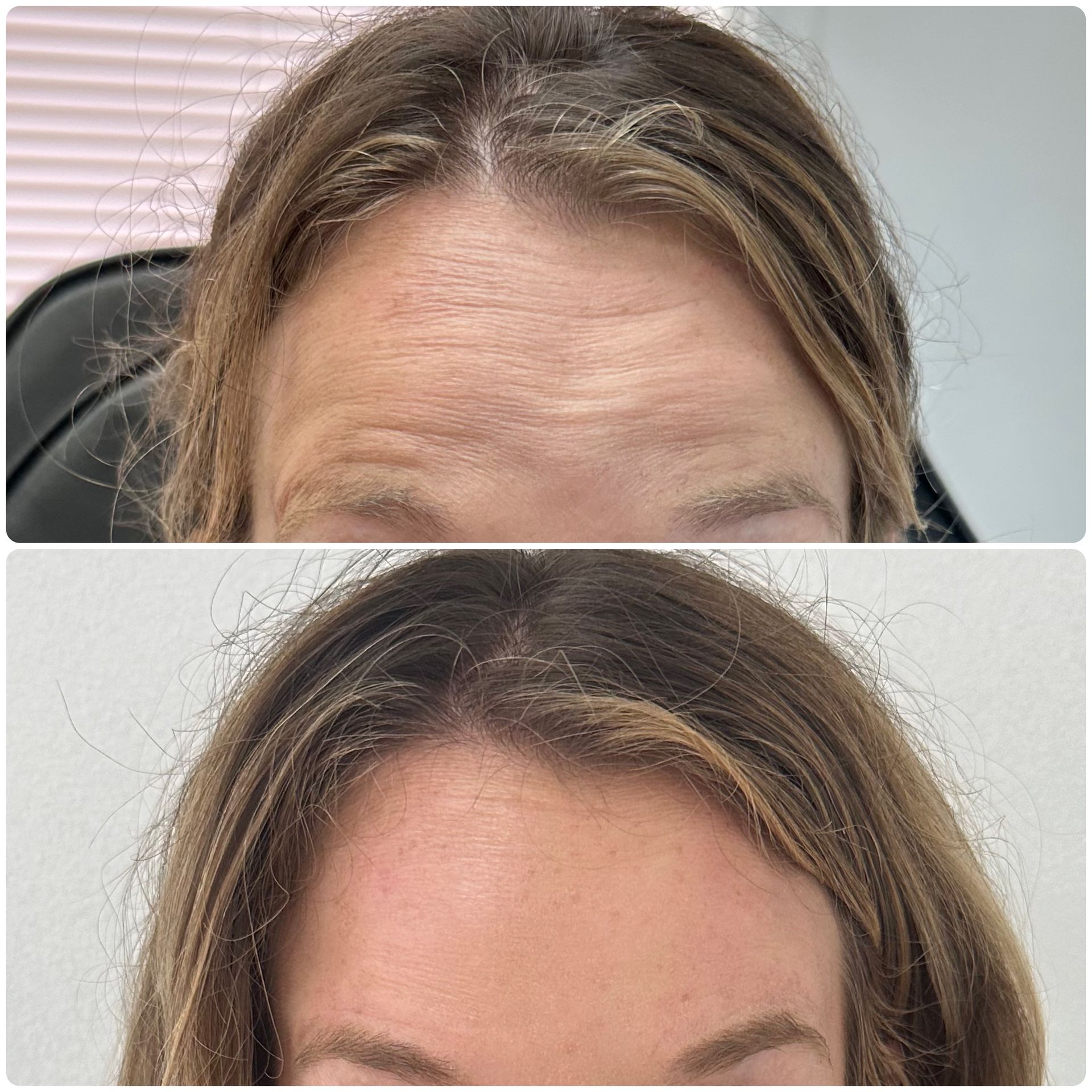 A before and after photo of a woman 's forehead.