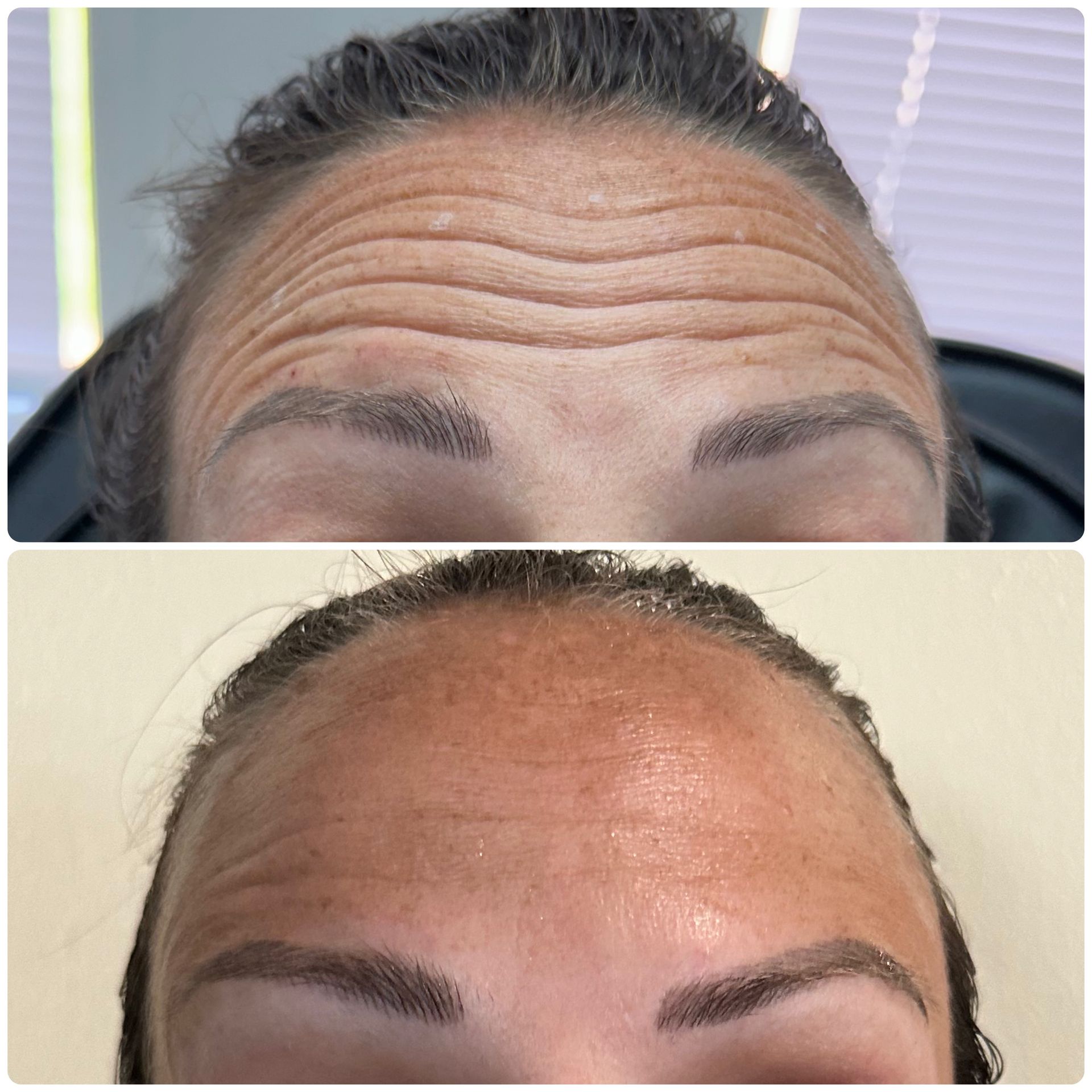 A before and after photo of a woman 's forehead.