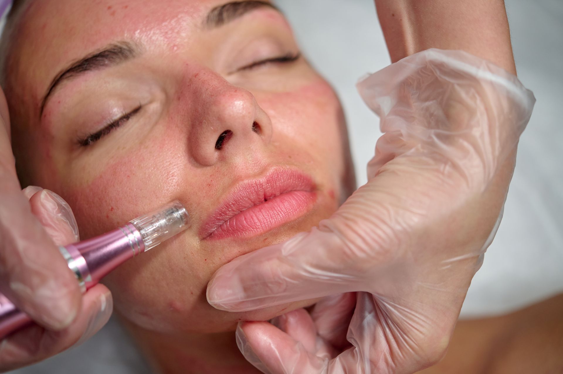 A woman is getting a microdermabrasion treatment on her face.