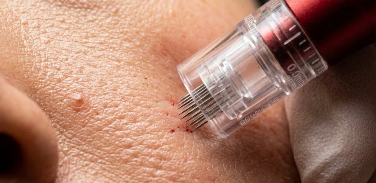 What Is Microneedling?
