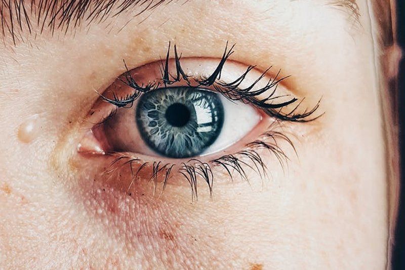 Thyroid Eye Disease