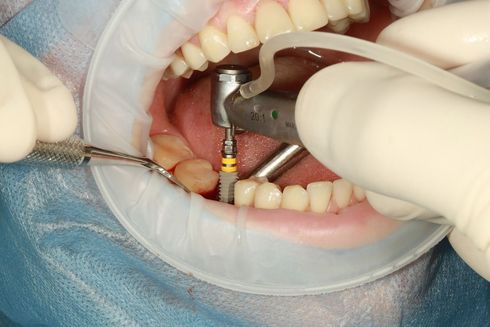 Dental implant surgery in progress, with drill and tools in a patient's open mouth.