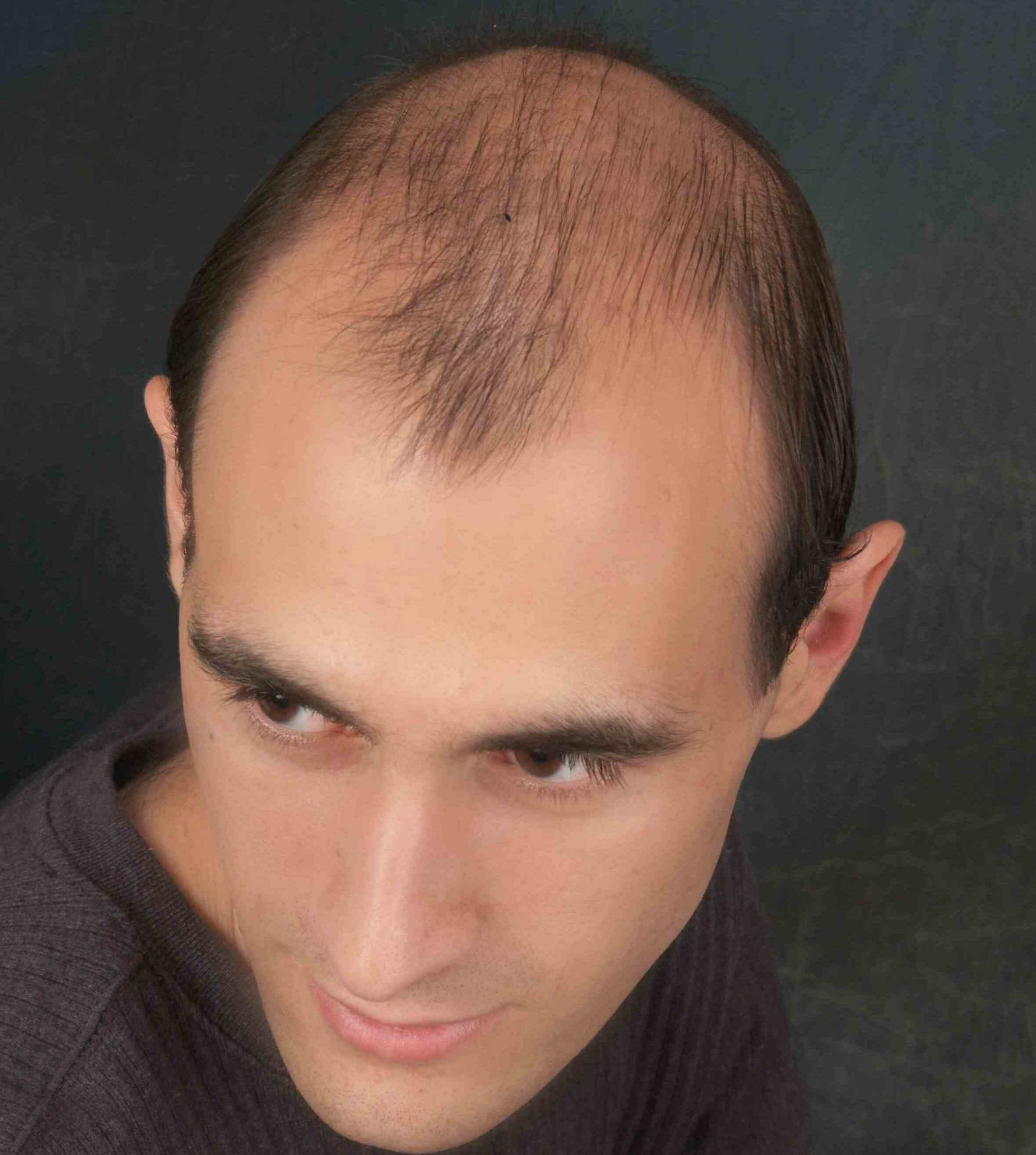 A man with a bald head looks at the camera