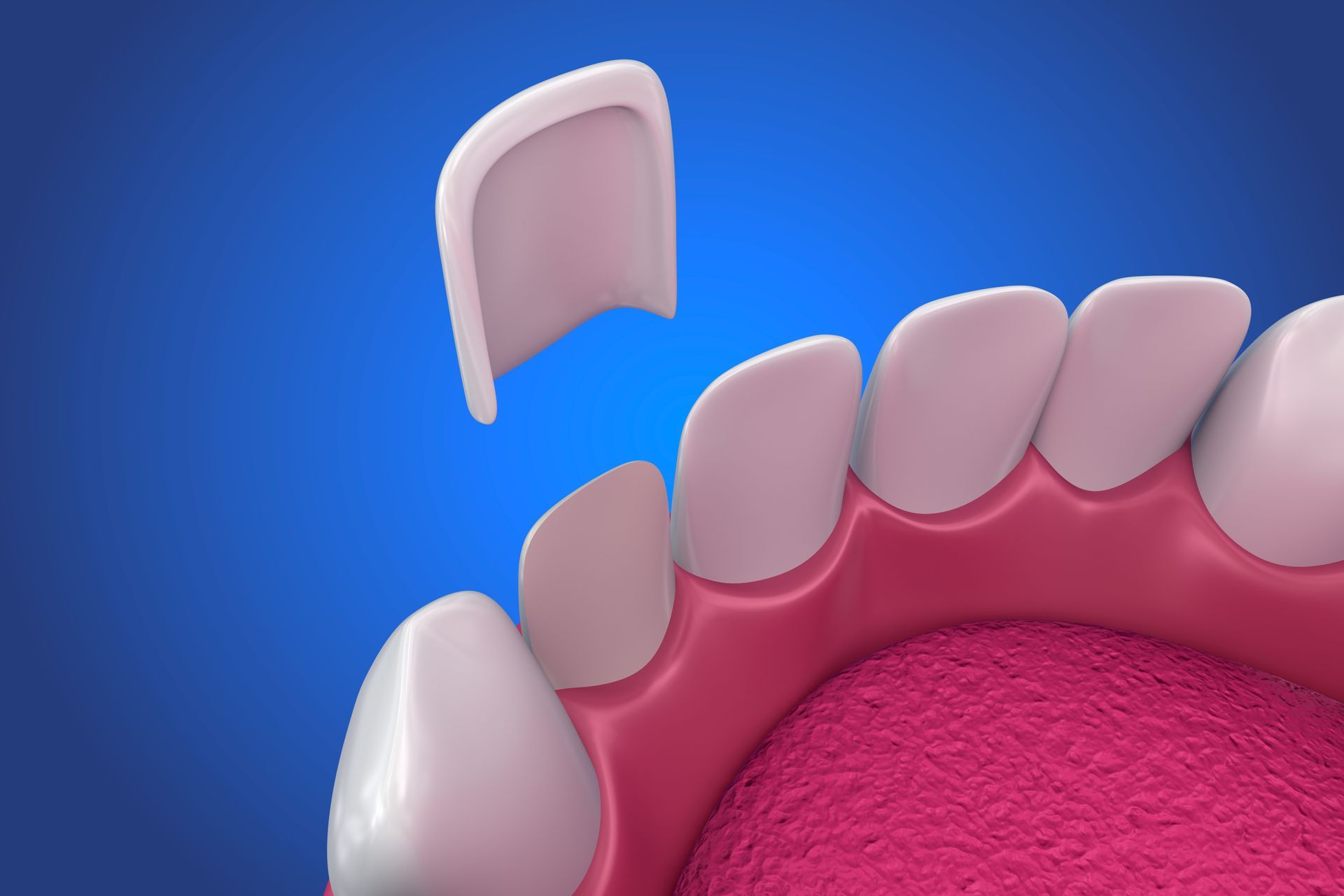 Veneers in Boise and Eagle, ID Dental Veneers