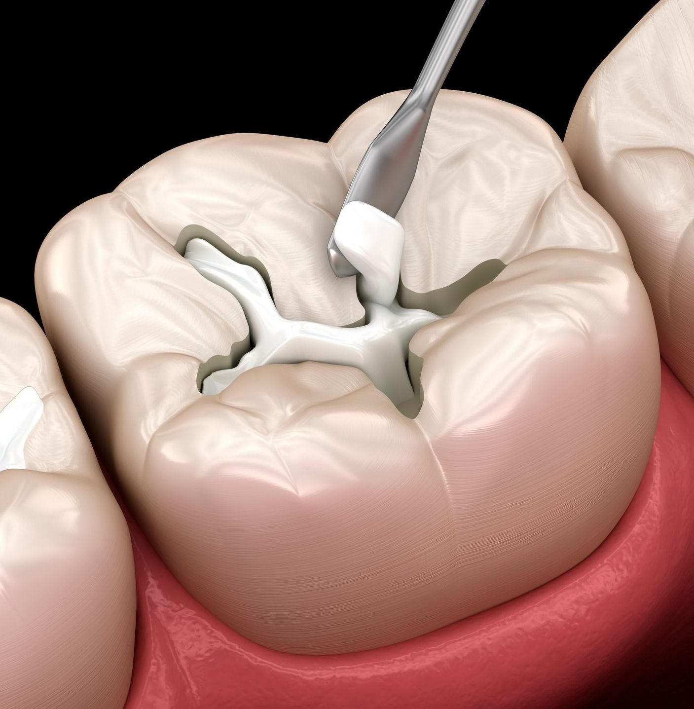 If you are concerned about cavitations consult our biological dentist in Boise, ID Close-up view of dental cavitation | cavitation therapy eagle id