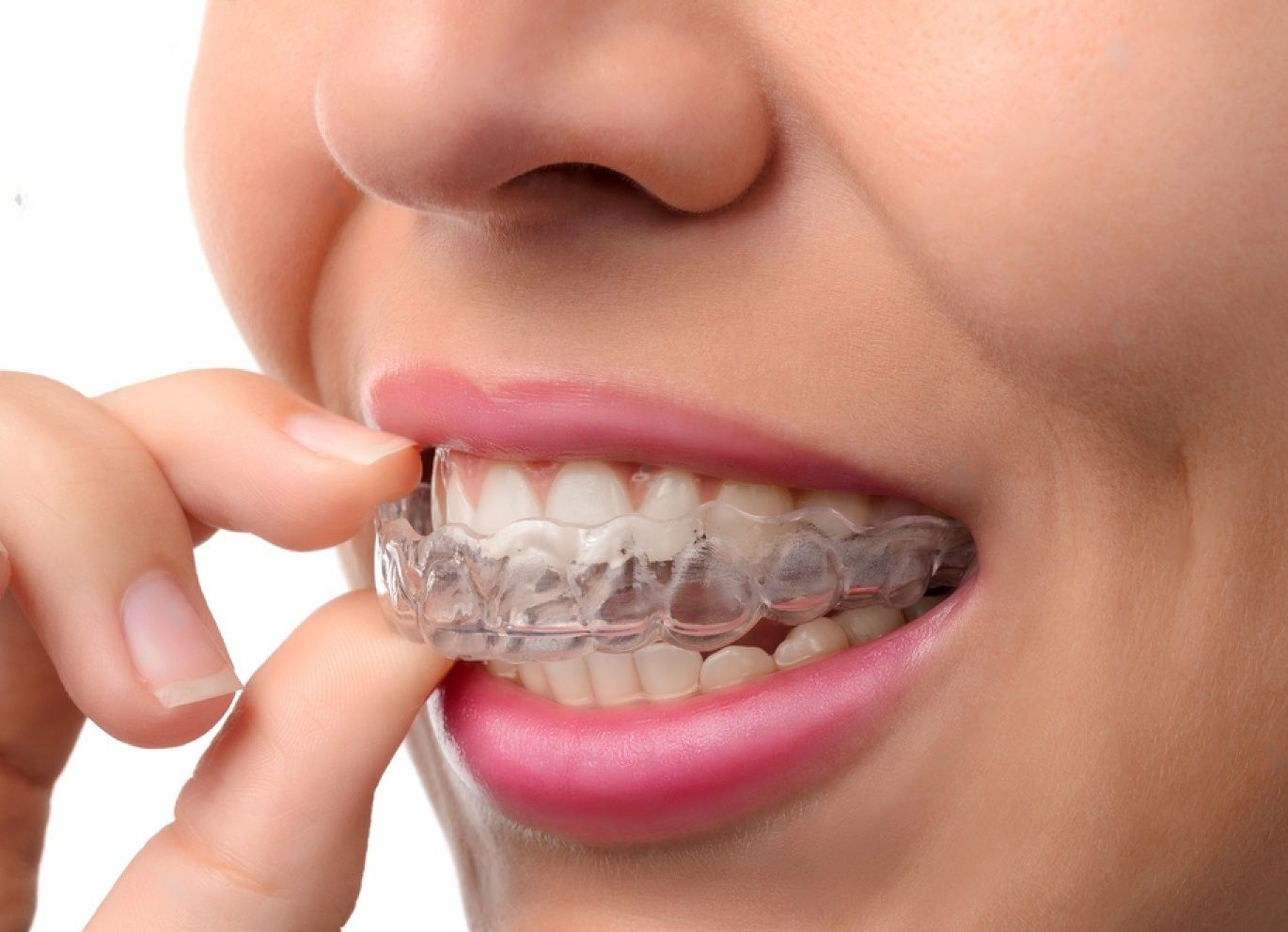 Aligners