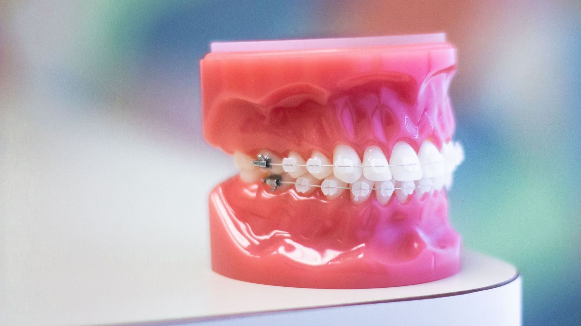 a model of a person 's teeth with braces on them