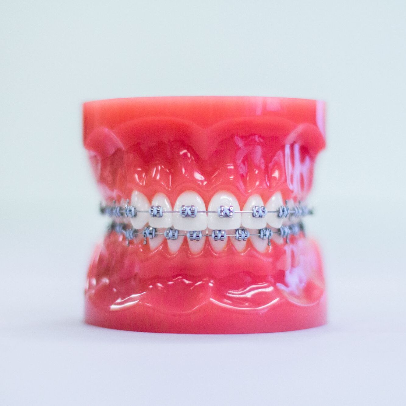 a model of a person 's teeth with braces on them