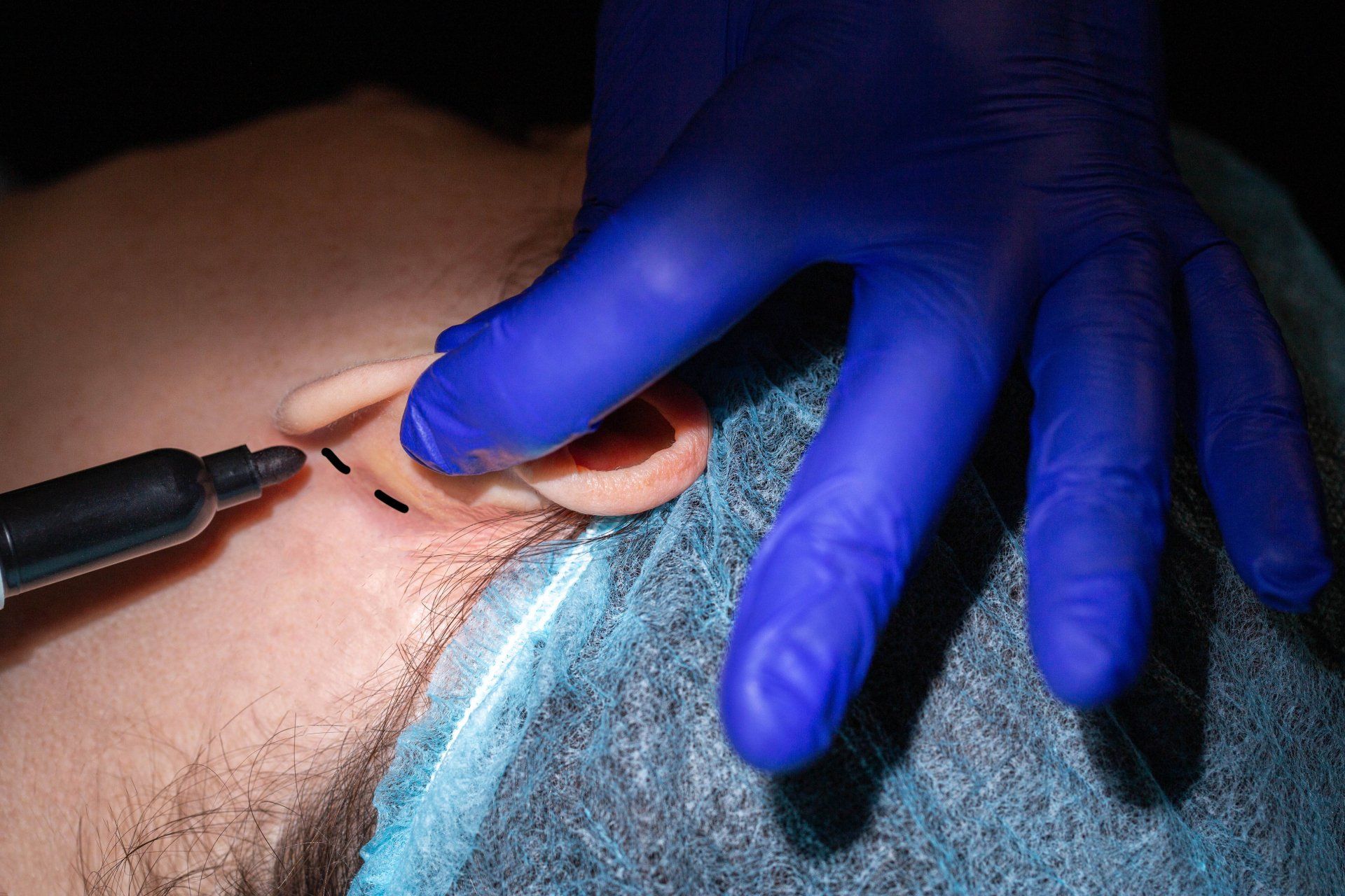 OTOPLASTICA