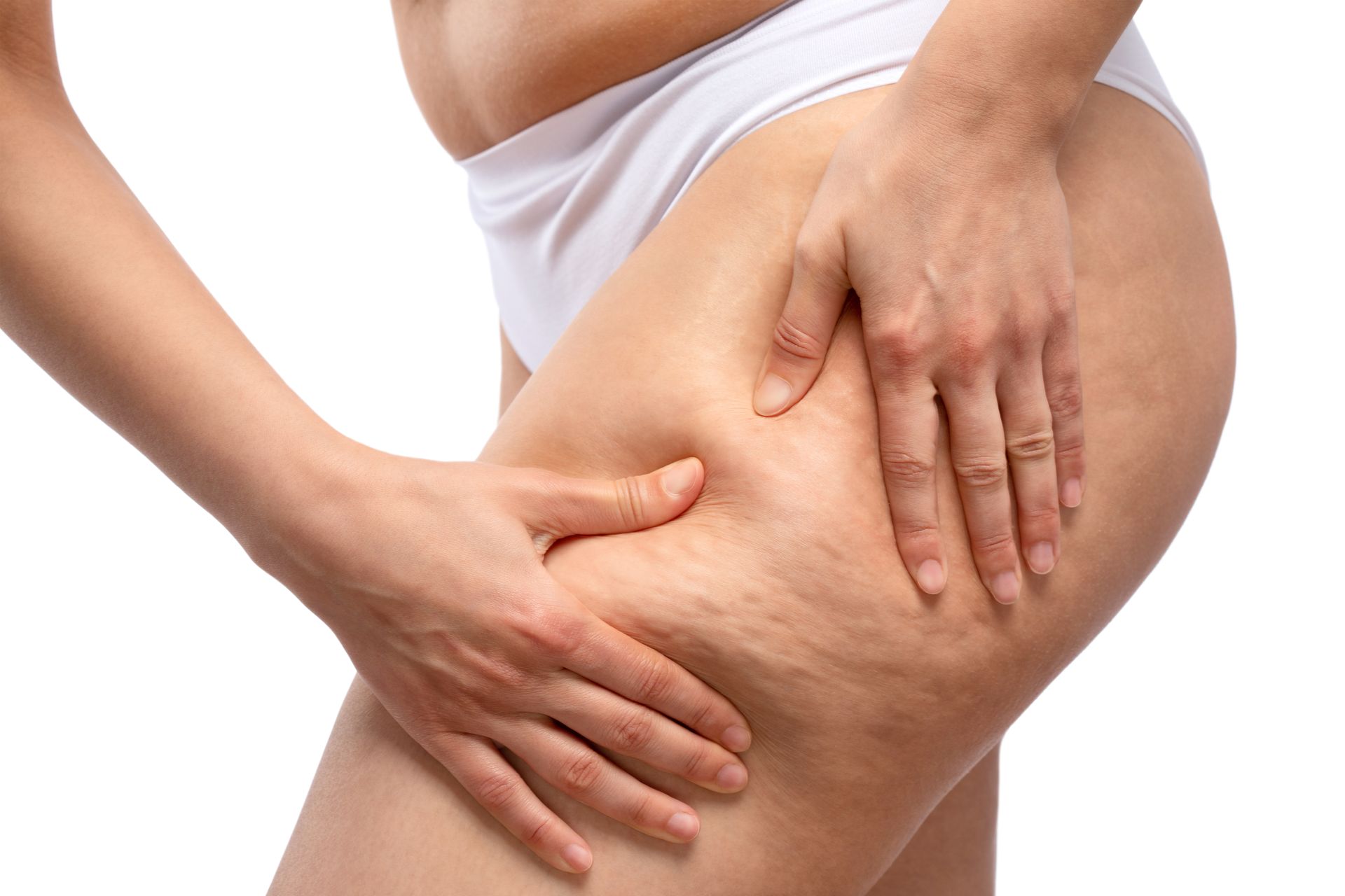 Close up of woman pinching cellulite on thigh, highlighting real skin texture, cellulite treatment