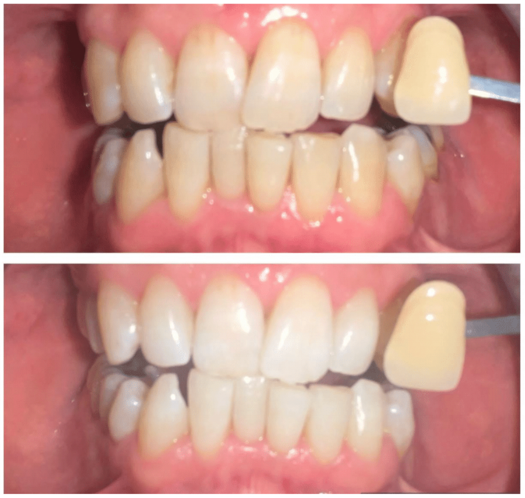 Teeth Alignment