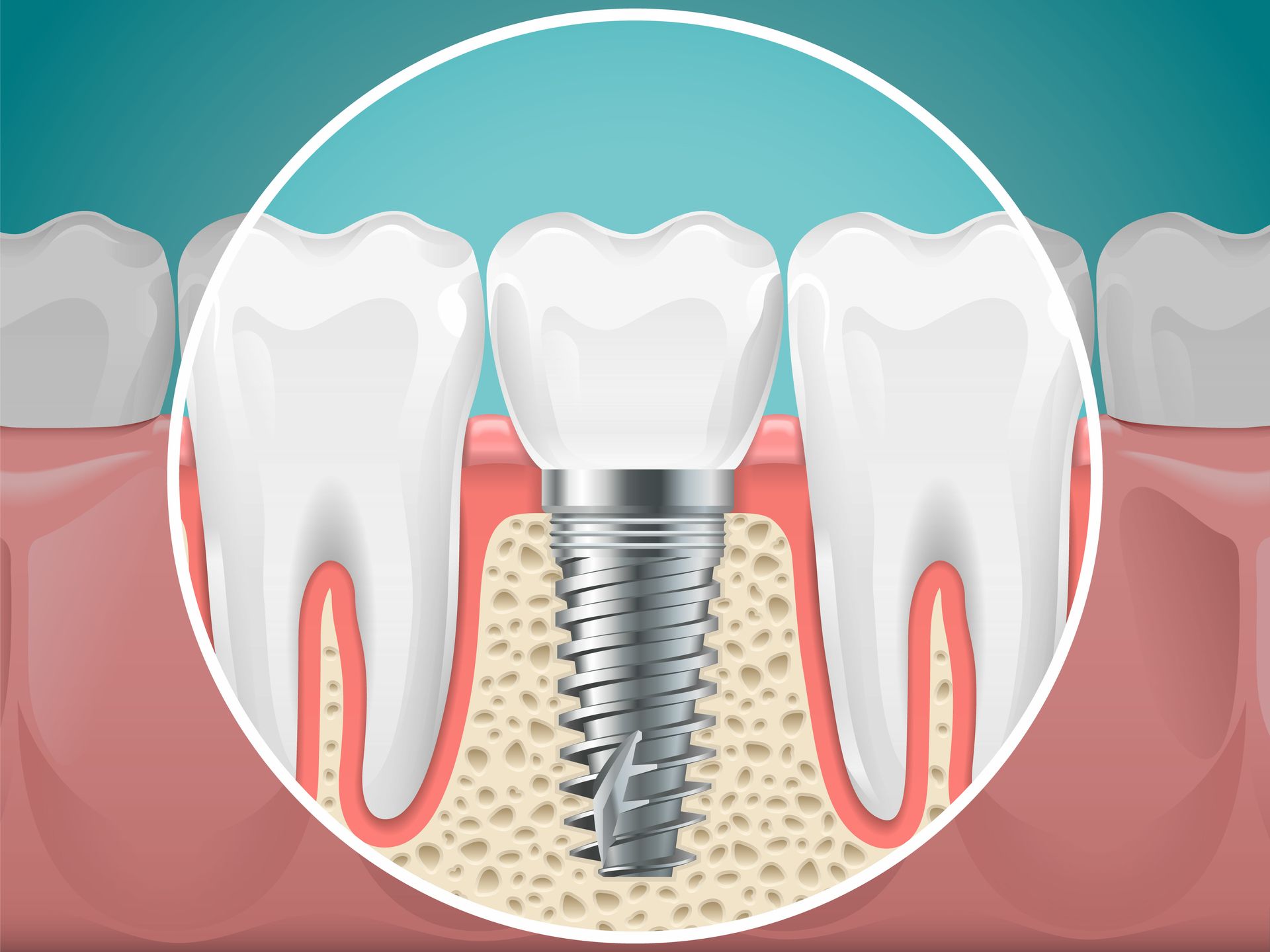 implant illustration in Attleboro, MA