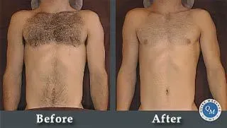 manscaping chest and arms, before & after manscaping beforemanscaping chest and arms, before & after and after