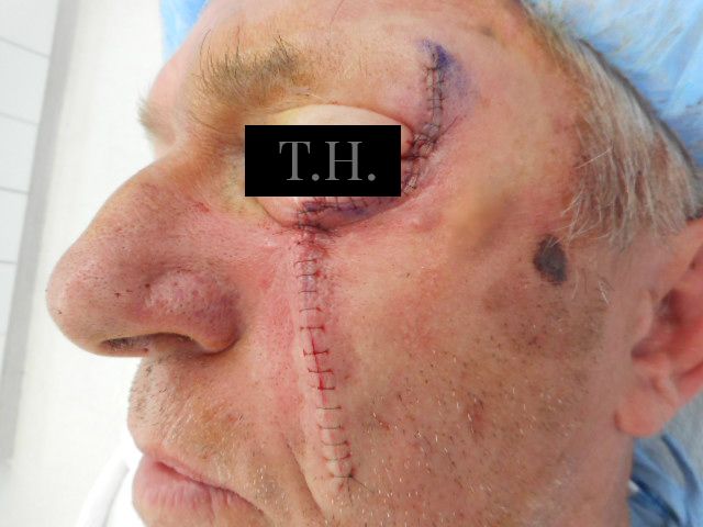 A close up of a mohs surgery scar