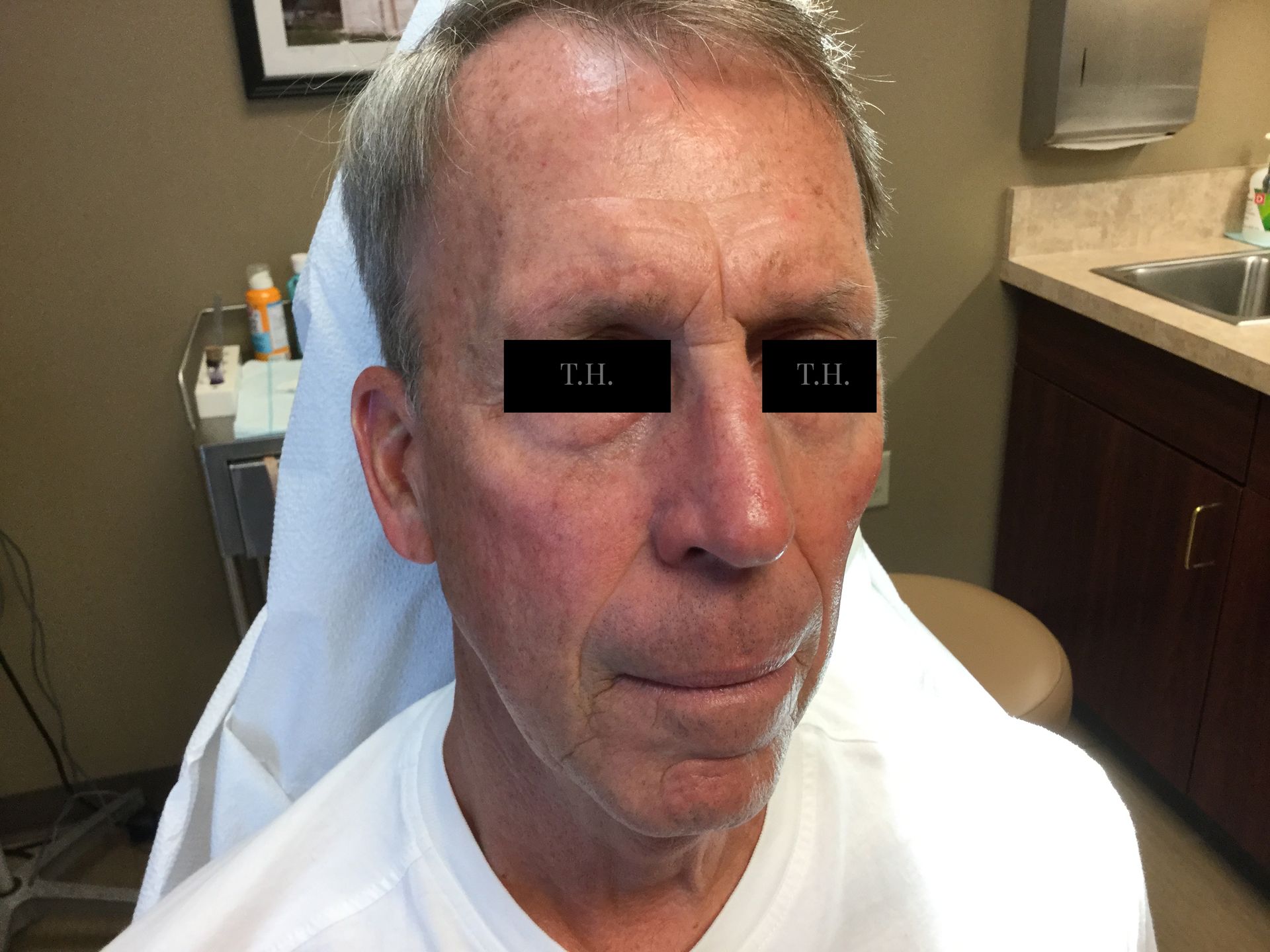 A woman with stitches on her face and nose