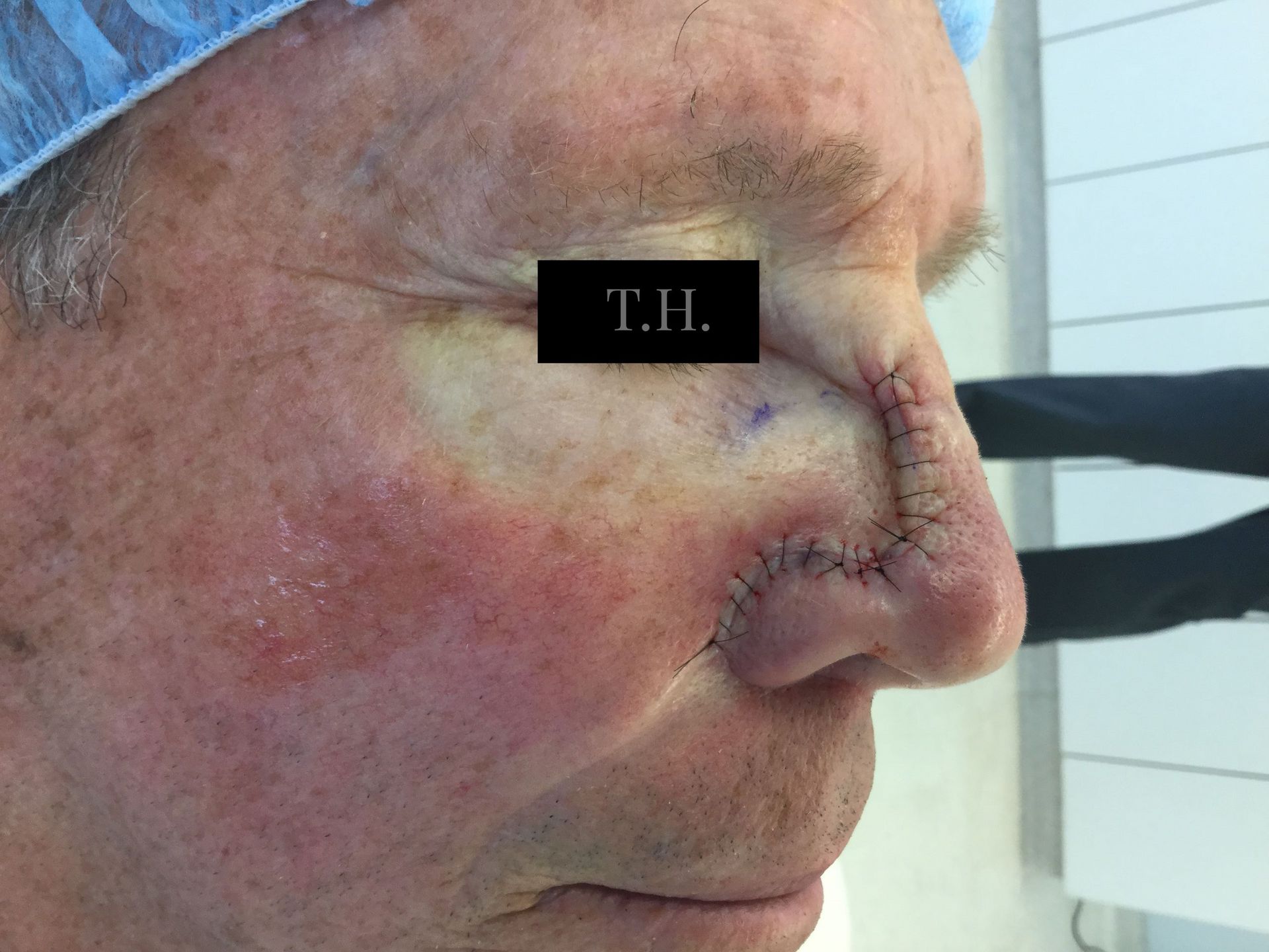 Close up of a woman's face who just underwent surgery