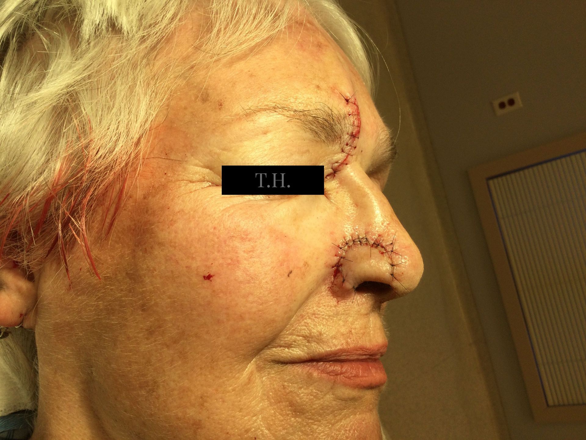 A close up of a mohs surgery scar