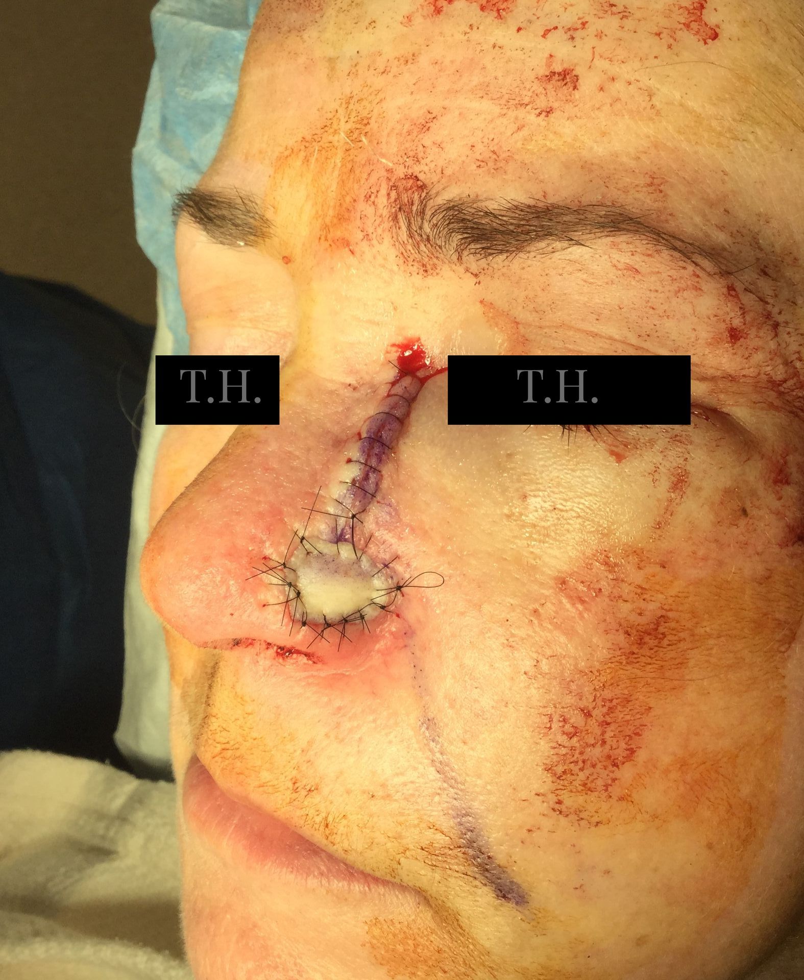 A close up of a mohs surgery scar
