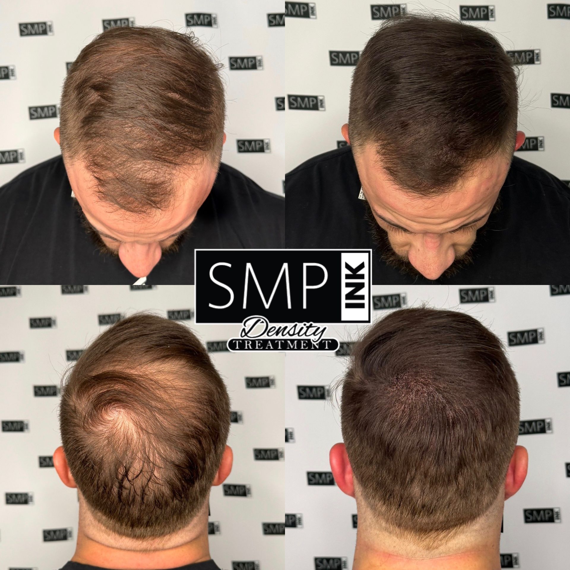 Hair restoration before-and-after collage showing thinning crown and fuller hair