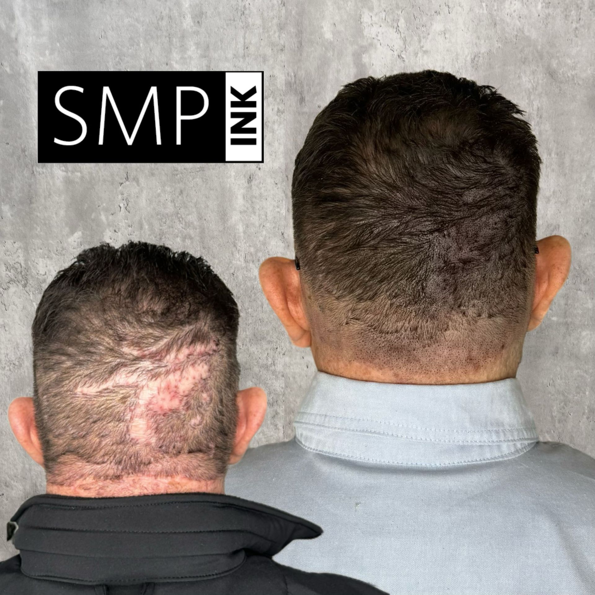 Before-and-after back-of-head views showing scalp micropigmentation tattoo coverage, with SMP Ink logo.