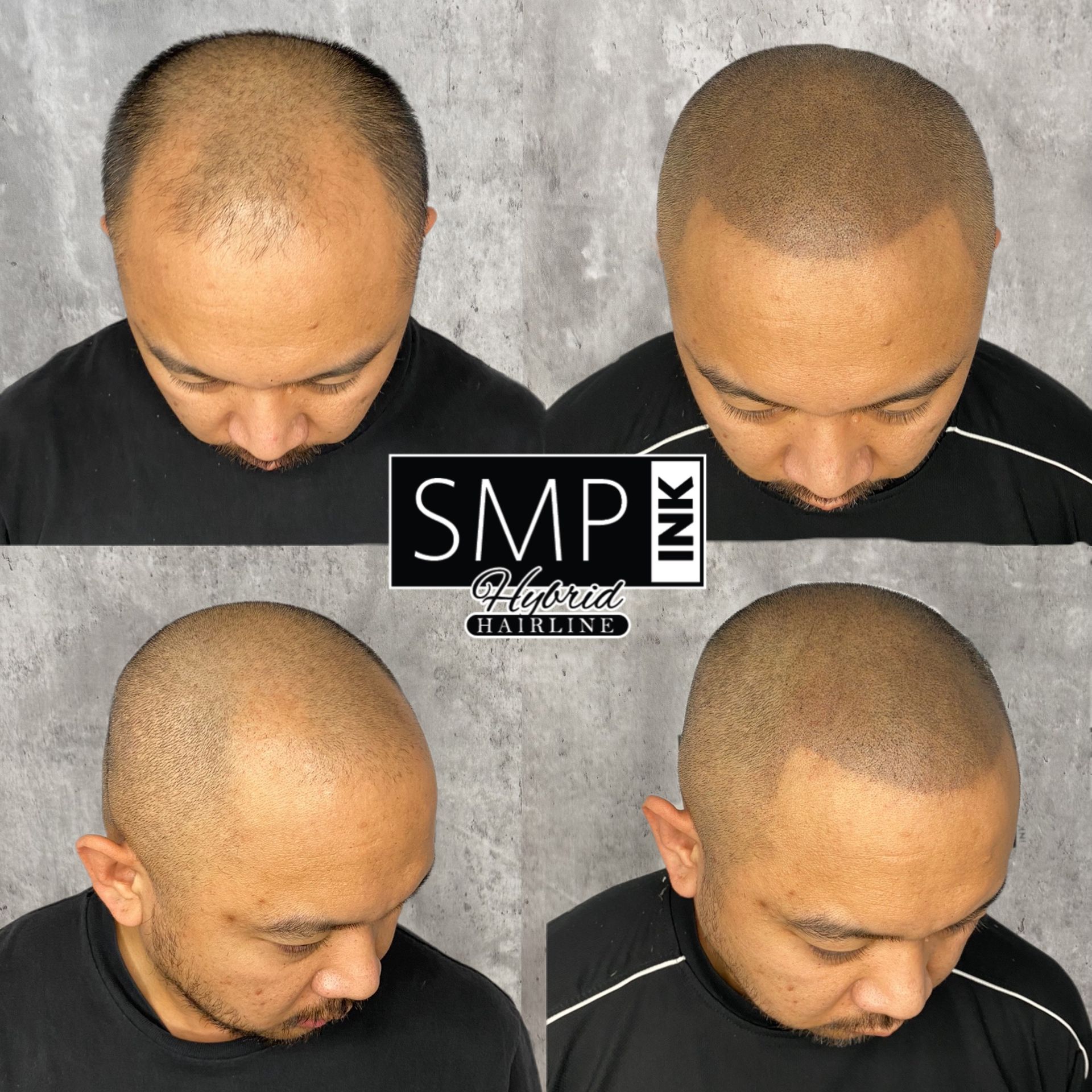 Before-and-after collage showing scalp micropigmentation on a shaved head, with hairline results from multiple angles