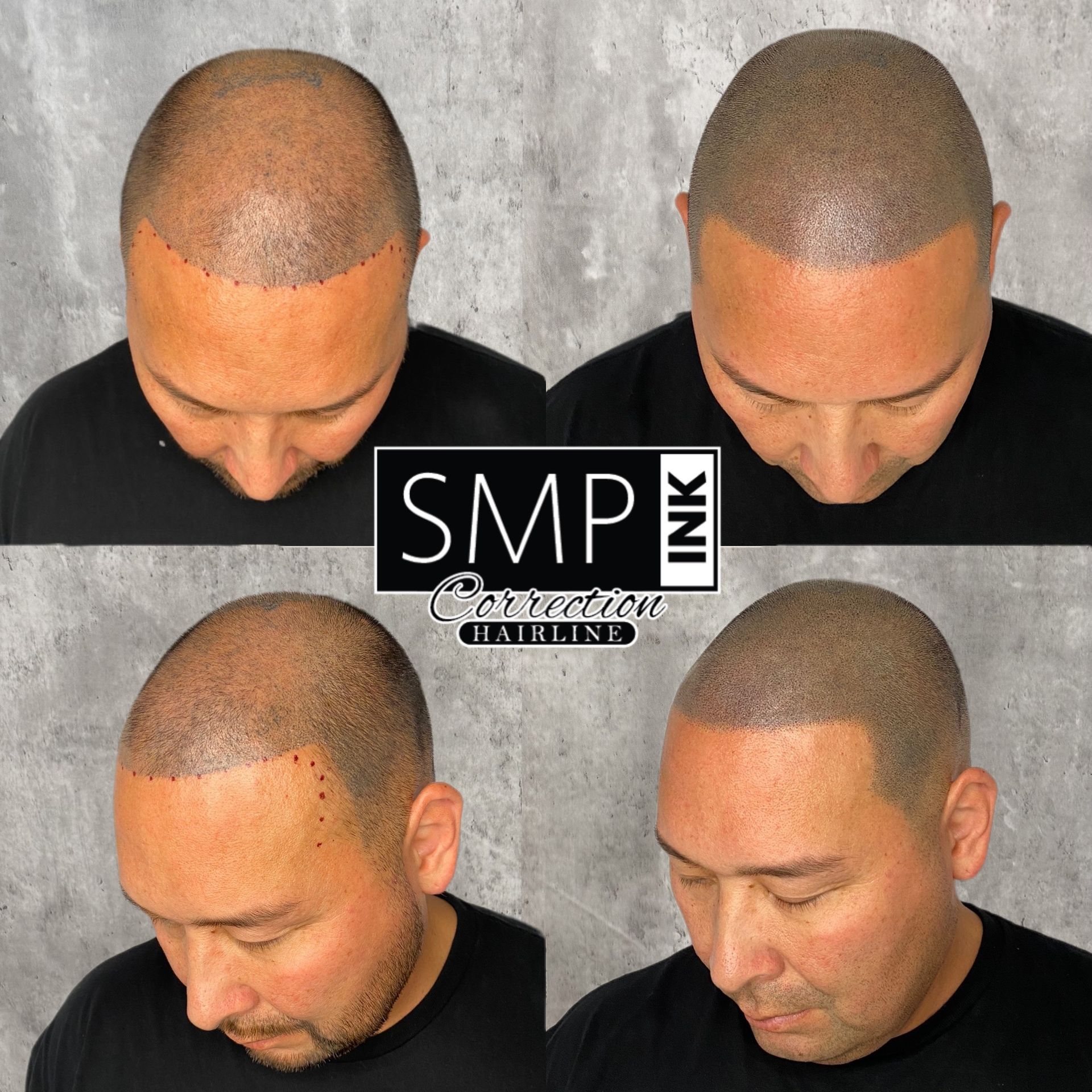 Four views of a man’s head showing scalp micropigmentation before and after results.
