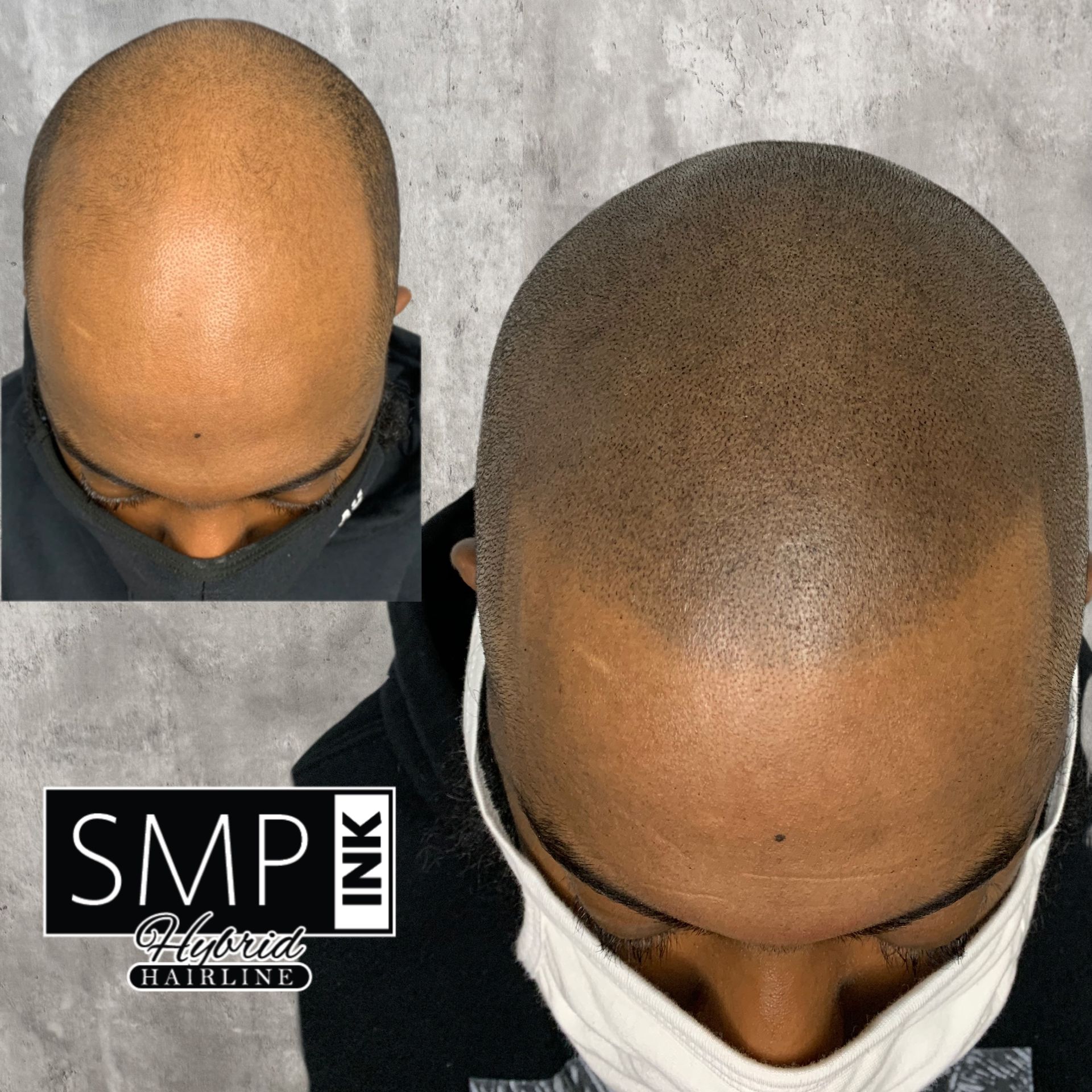 Top-down close-up of a shaved scalp before and after SMP treatment, shown side by side.