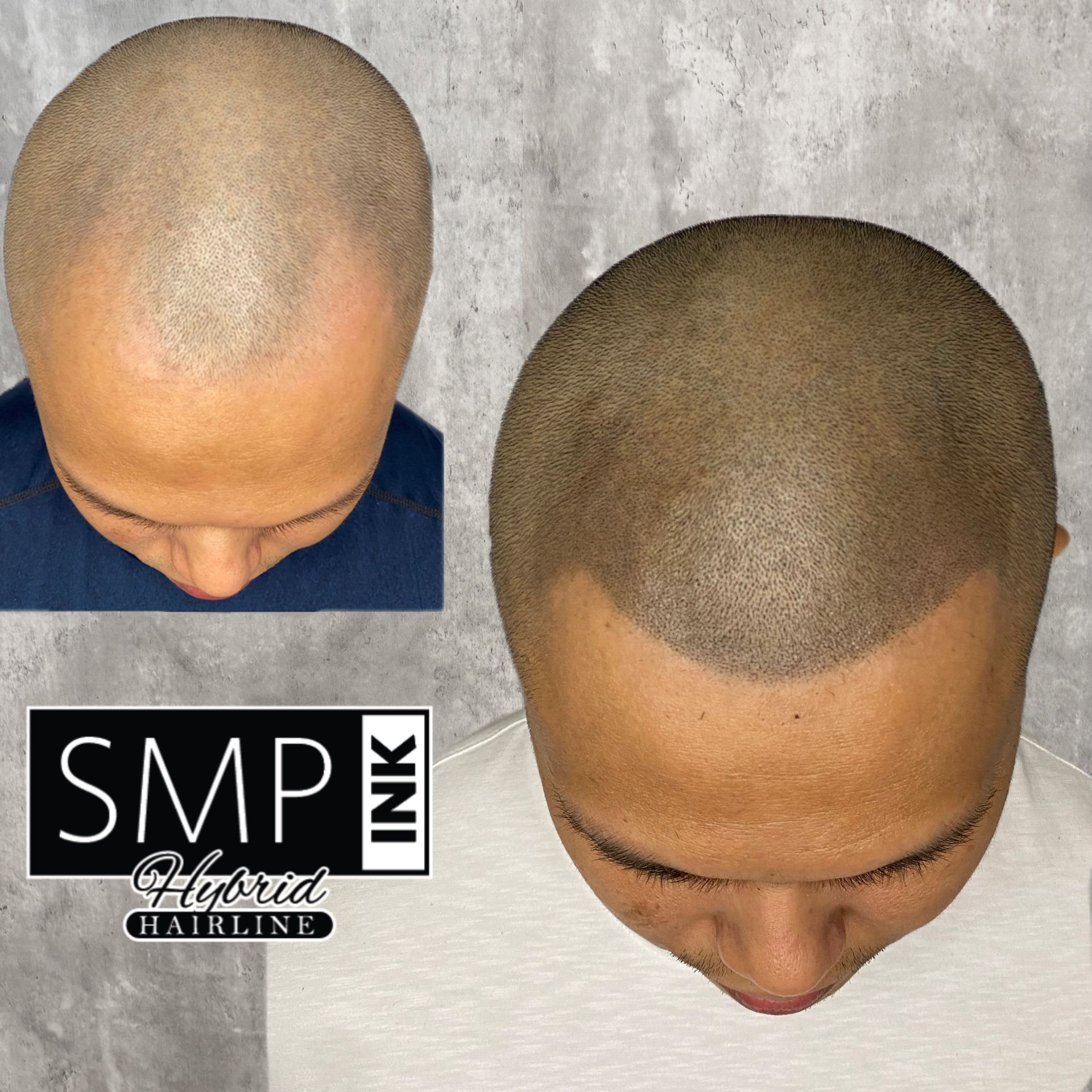 Before-and-after scalp micropigmentation showing a balding scalp transformed into a fuller hairline.