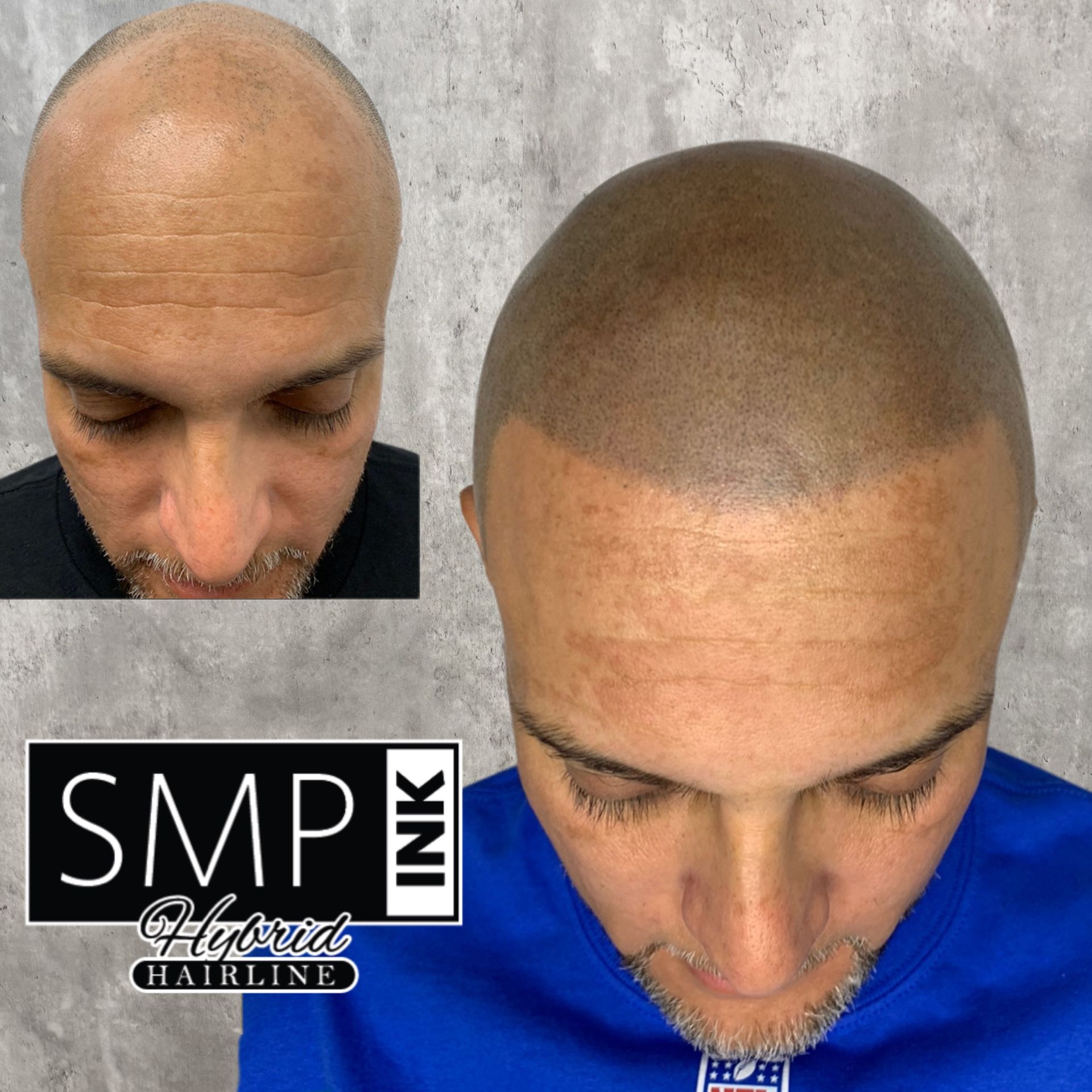 Before-and-after scalp micropigmentation showing a shaved head with a fuller-looking hairline.