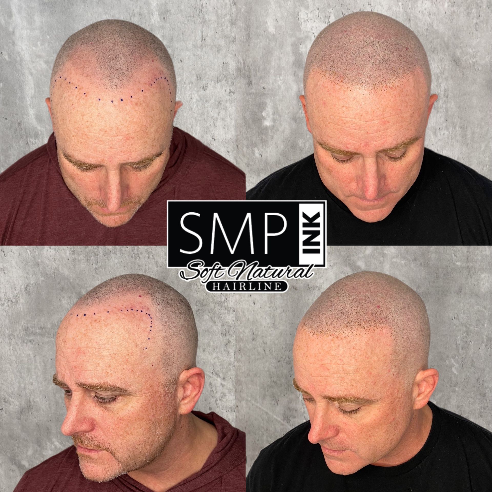 Before-and-after scalp micropigmentation examples showing shaved heads with improved hairline density.