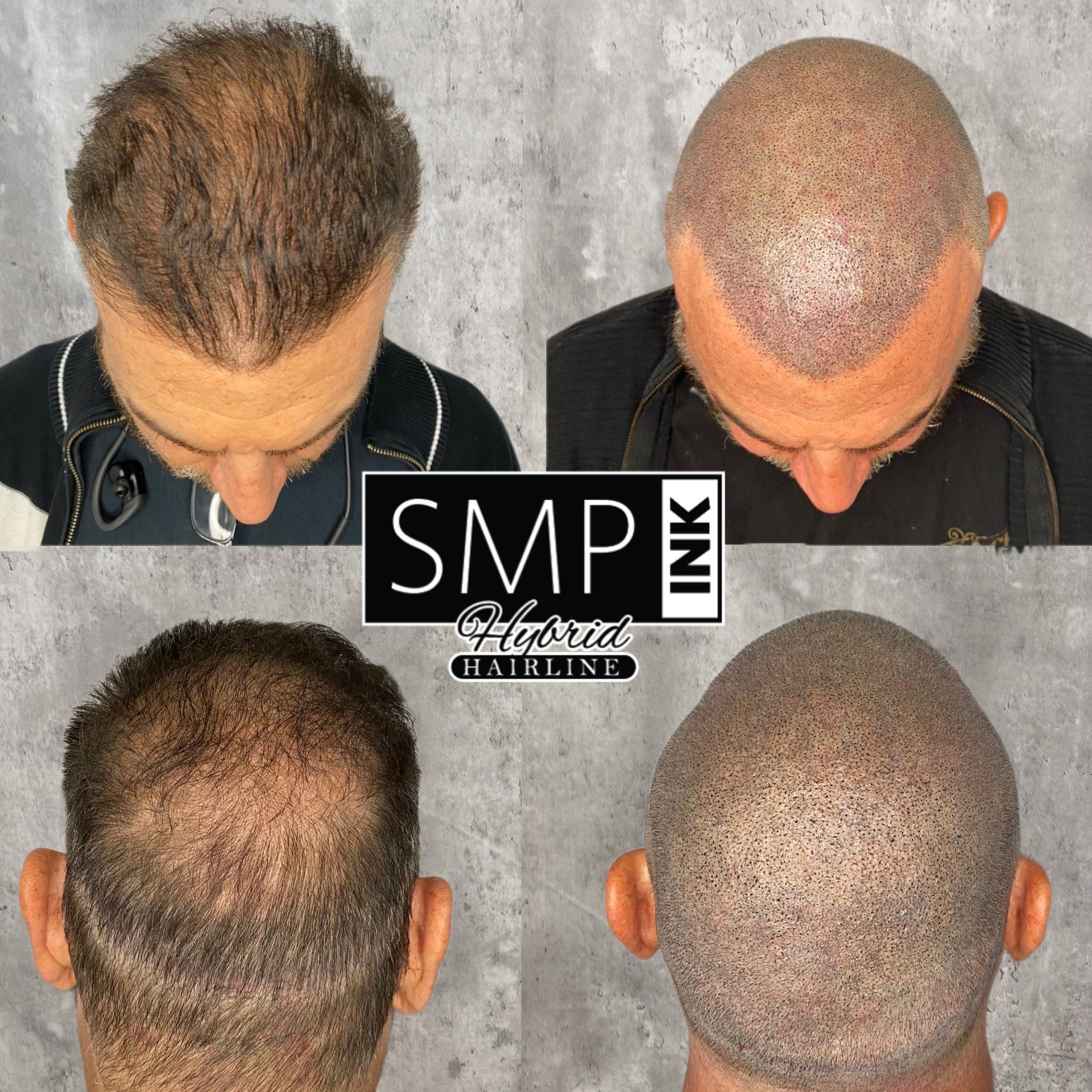 Top and back views of a scalp before and after hair restoration treatment comparison.