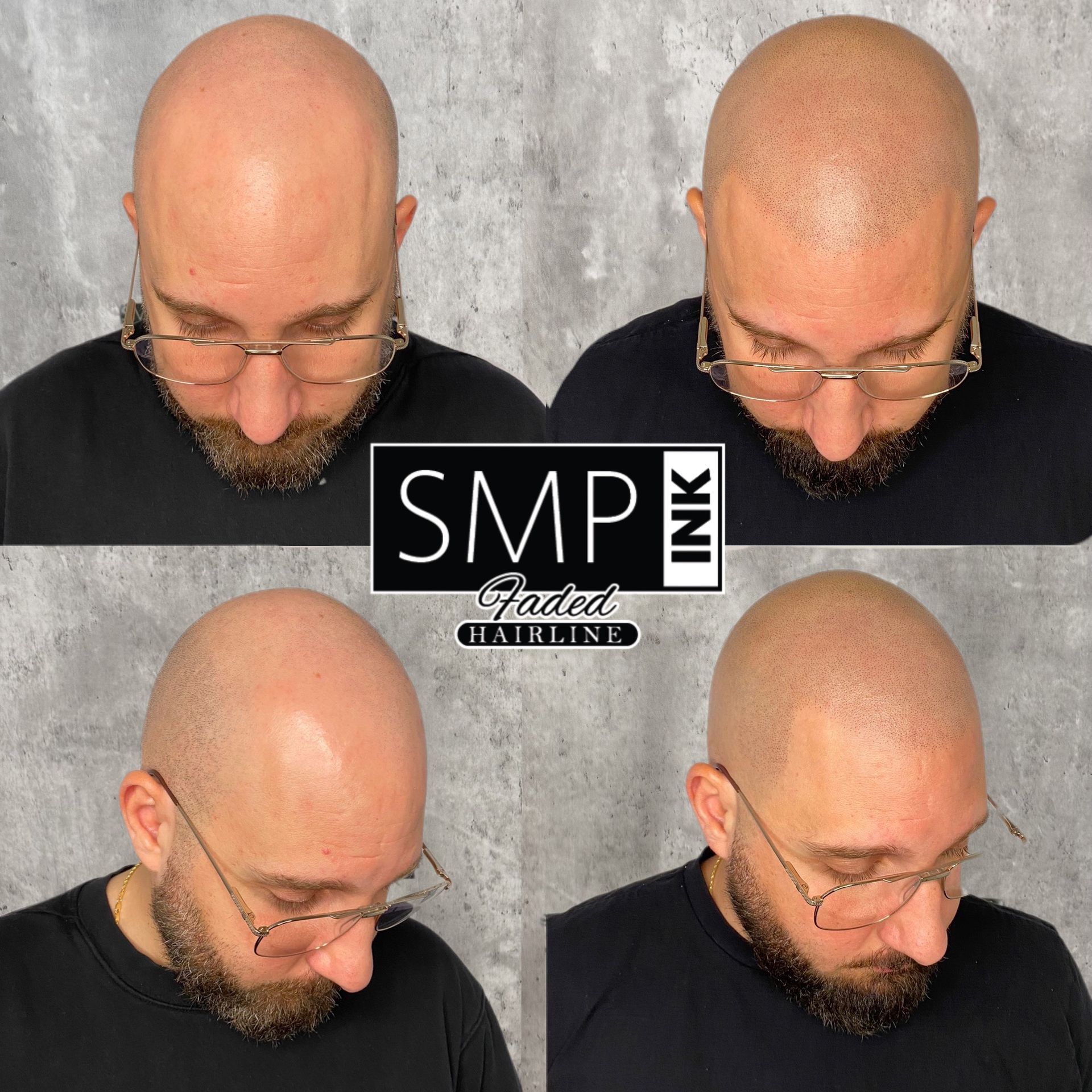 Four views of a bald man's head showing scalp micropigmentation results with “SMP Ink” logo center