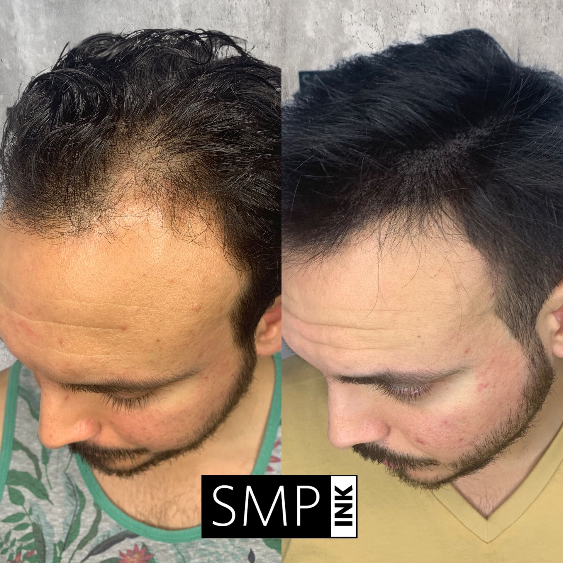 Side-by-side top views of a man’s thinning hair before and after a fuller, styled haircut