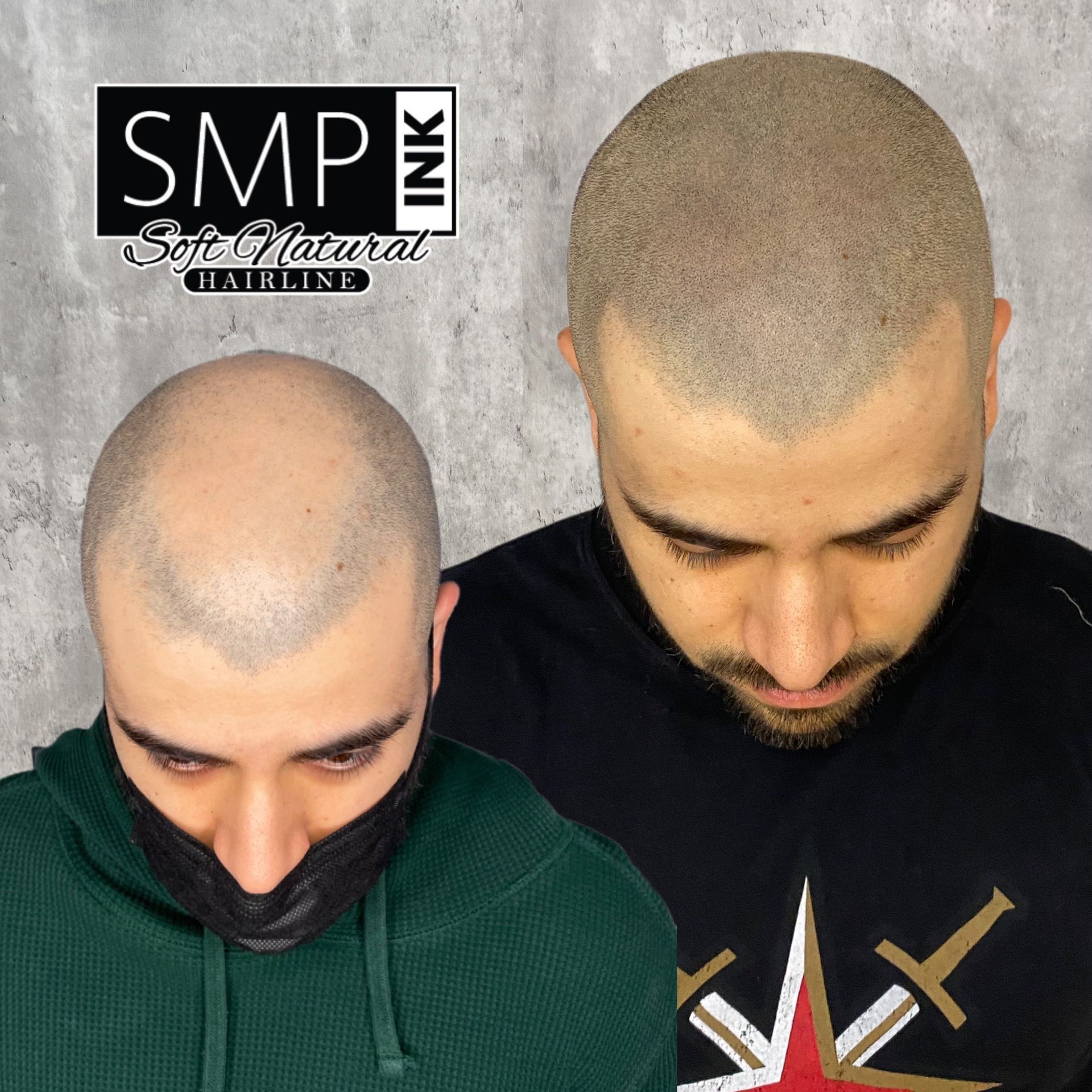 Split-view of a man's shaved scalp before and after scalp micropigmentation treatment