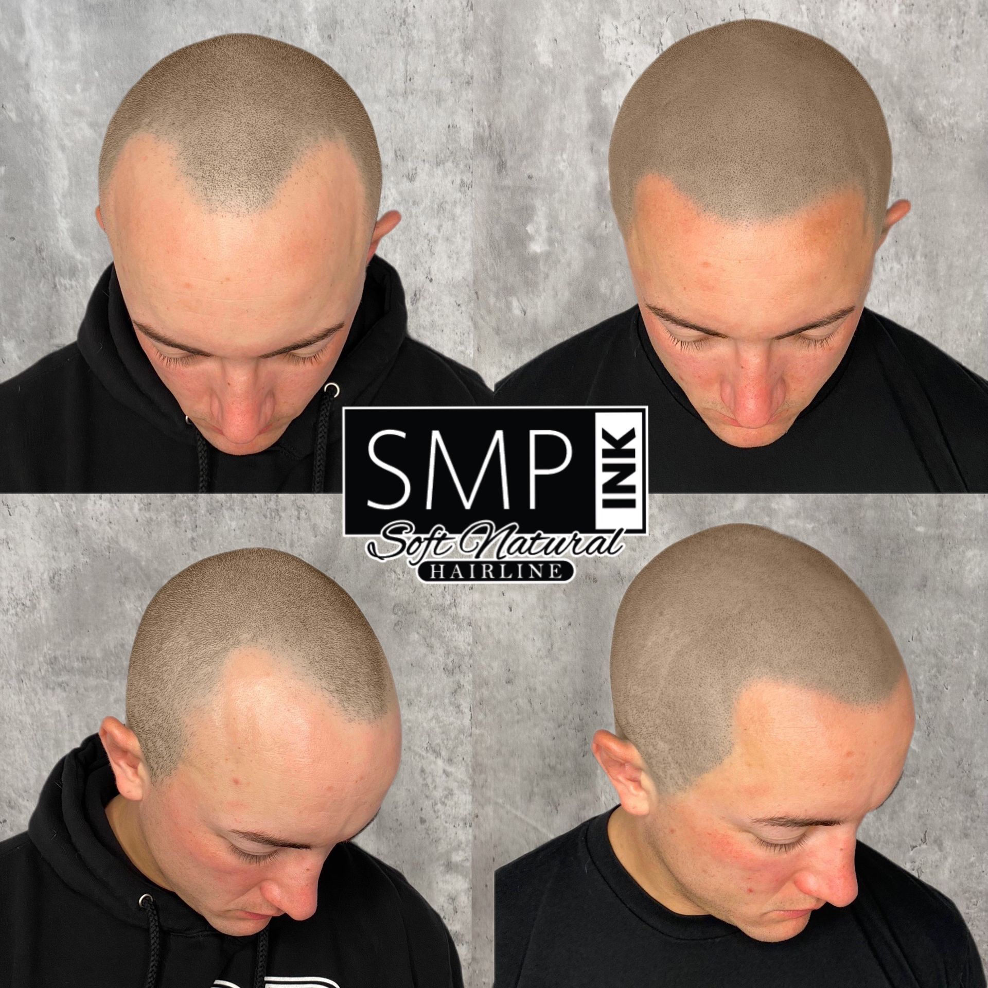 Four views of a shaved head with scalp micropigmentation before and after on a gray background.