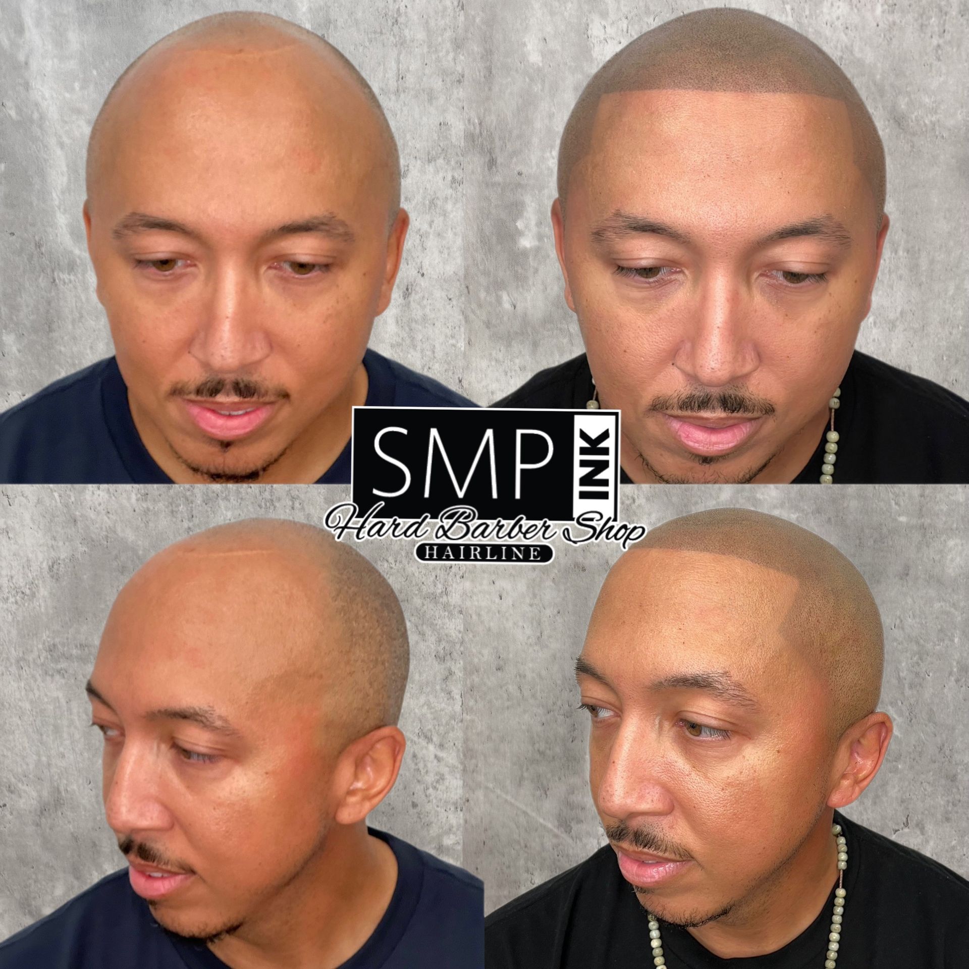 Before-and-after collage of a bald man with scalp micropigmentation, shown from front and side angles.