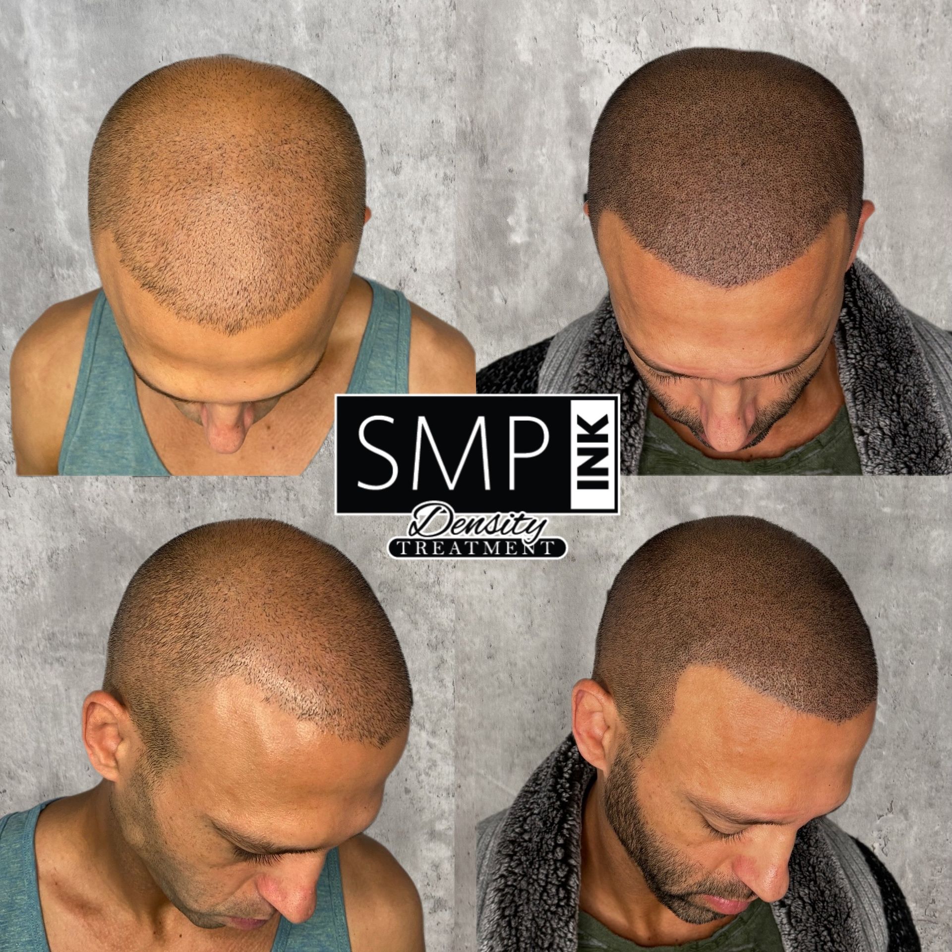 Before-and-after scalp micropigmentation comparison with four views and SMP Ink logo.
