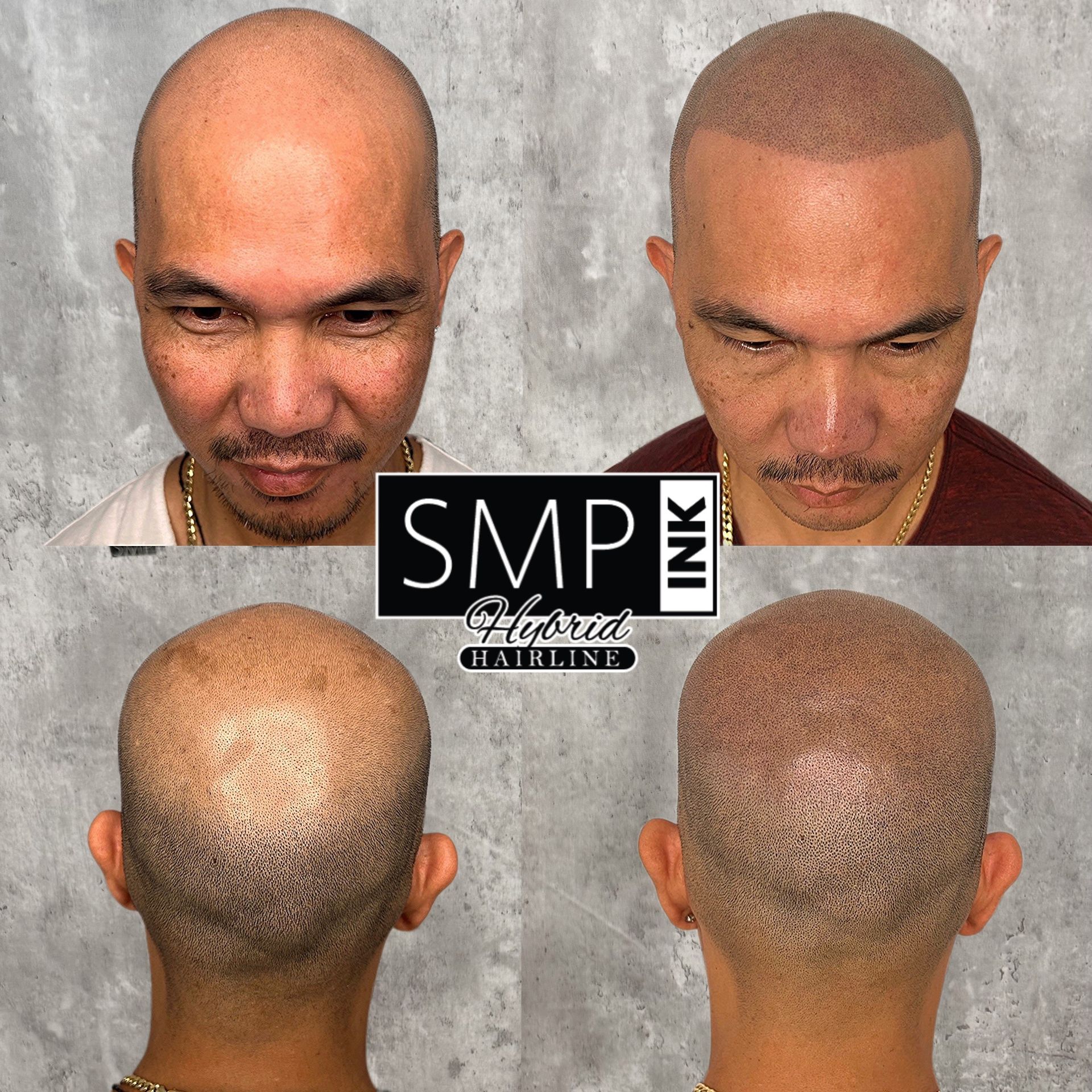 Hair restoration before-and-after collage showing scalp coverage from front and back views.