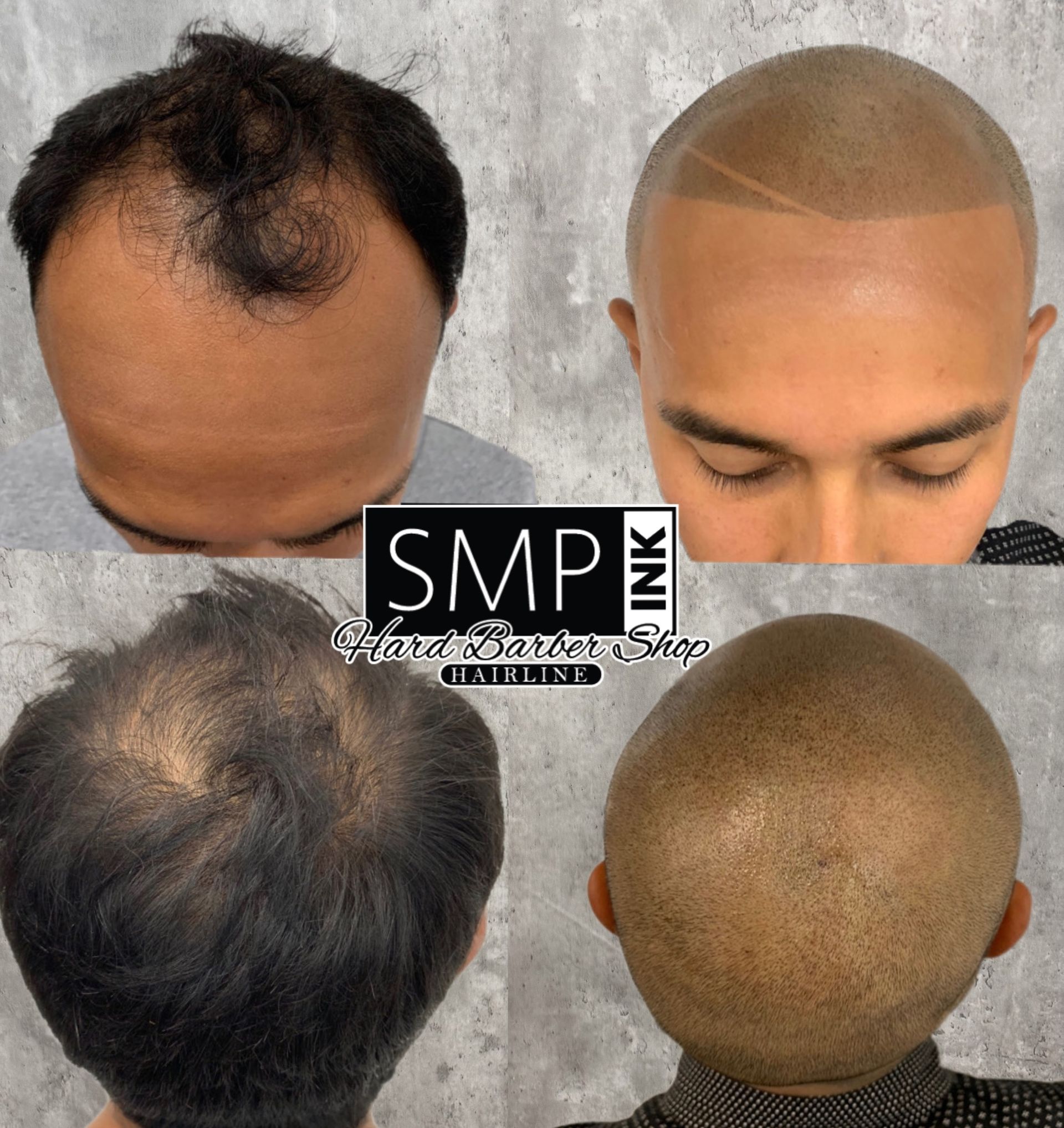 Top-and-back views of a scalp before and after hair restoration, showing thinning and fuller coverage.