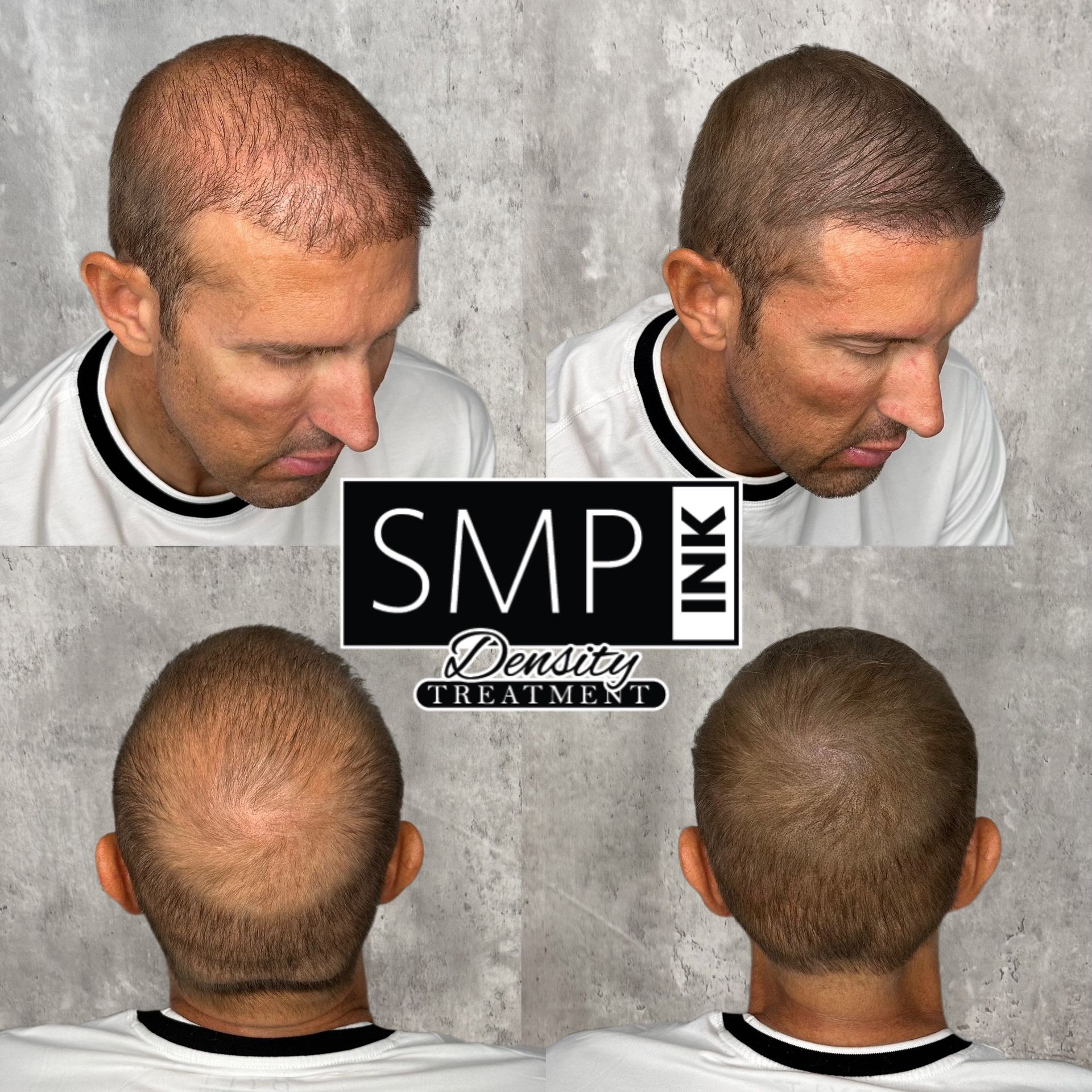 Four views of a man’s head showing scalp micropigmentation results, with SMP Ink logo centered.