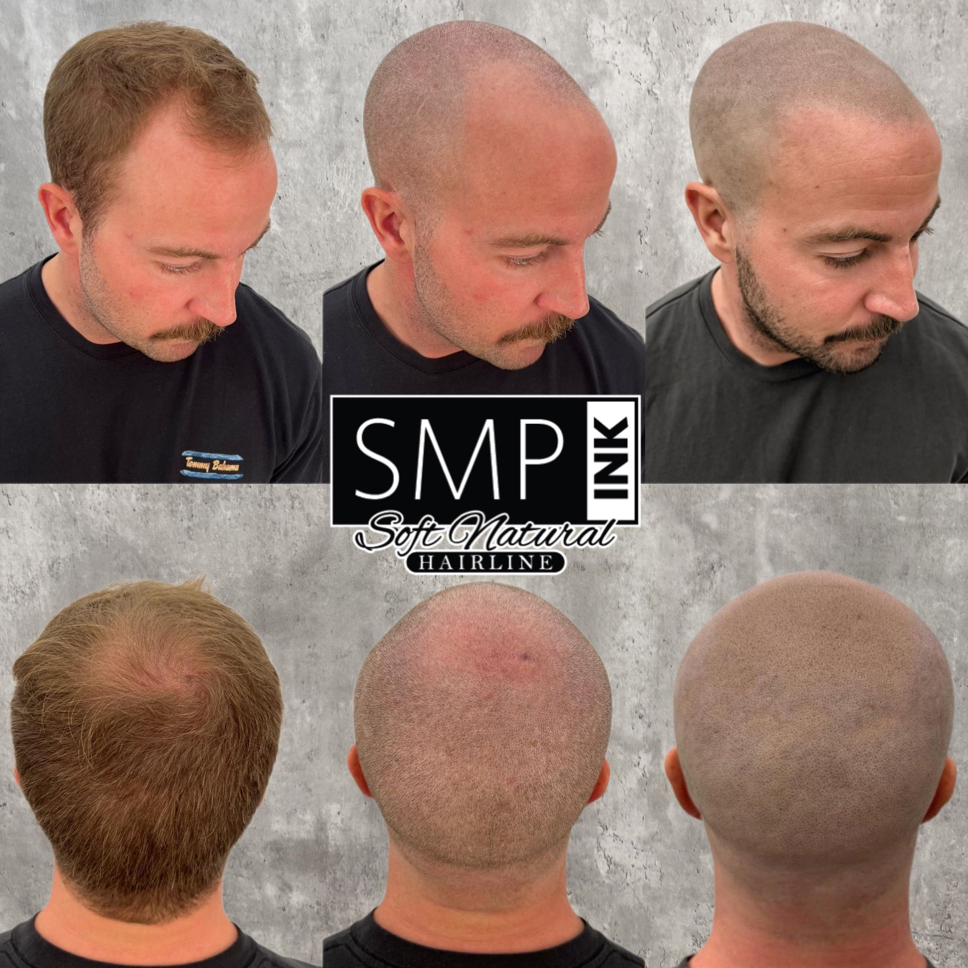 Hair transplant before-and-after collage showing thinning crown and fuller hair restoration from multiple angles